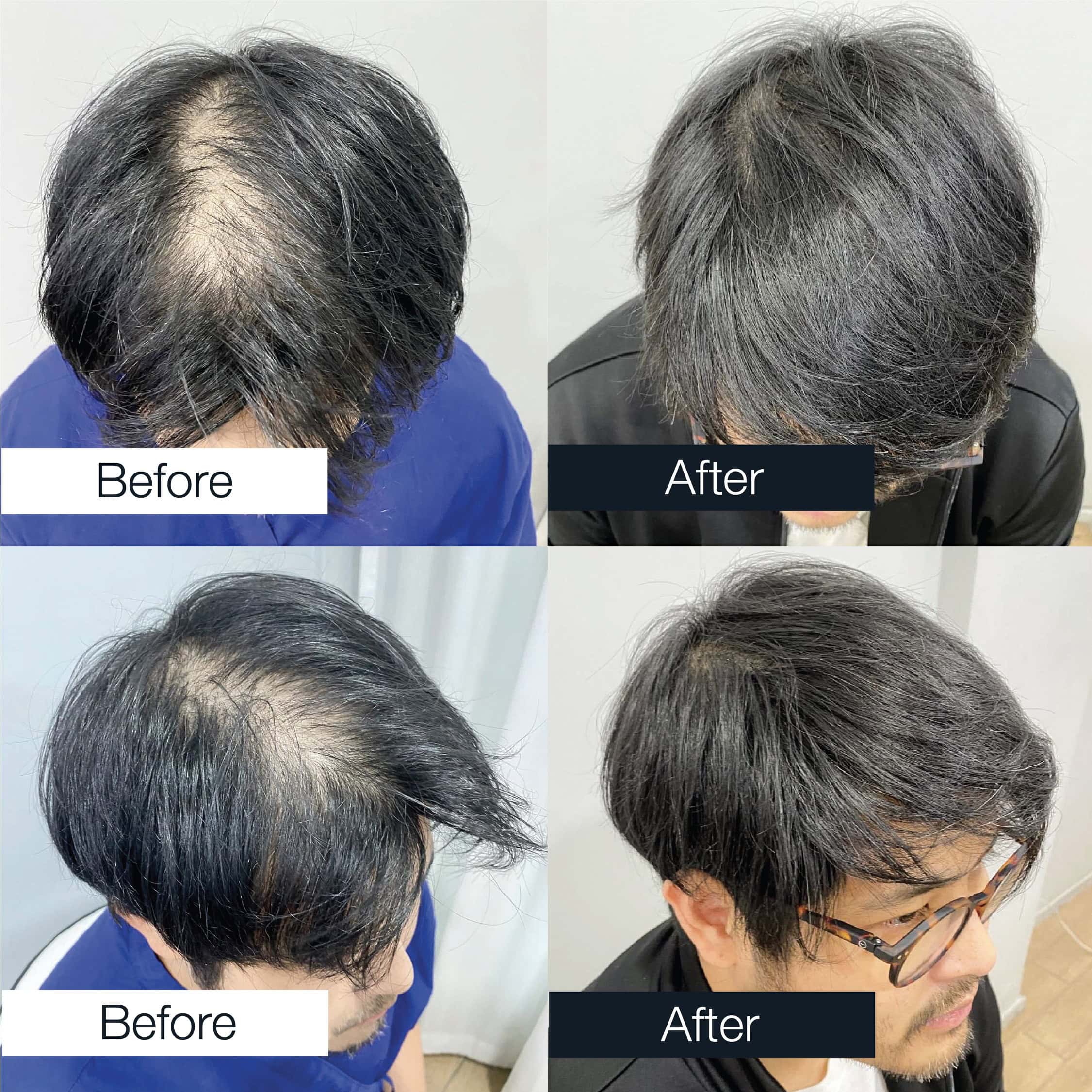 A before-and-after comparison of a person's hair restoration procedure results