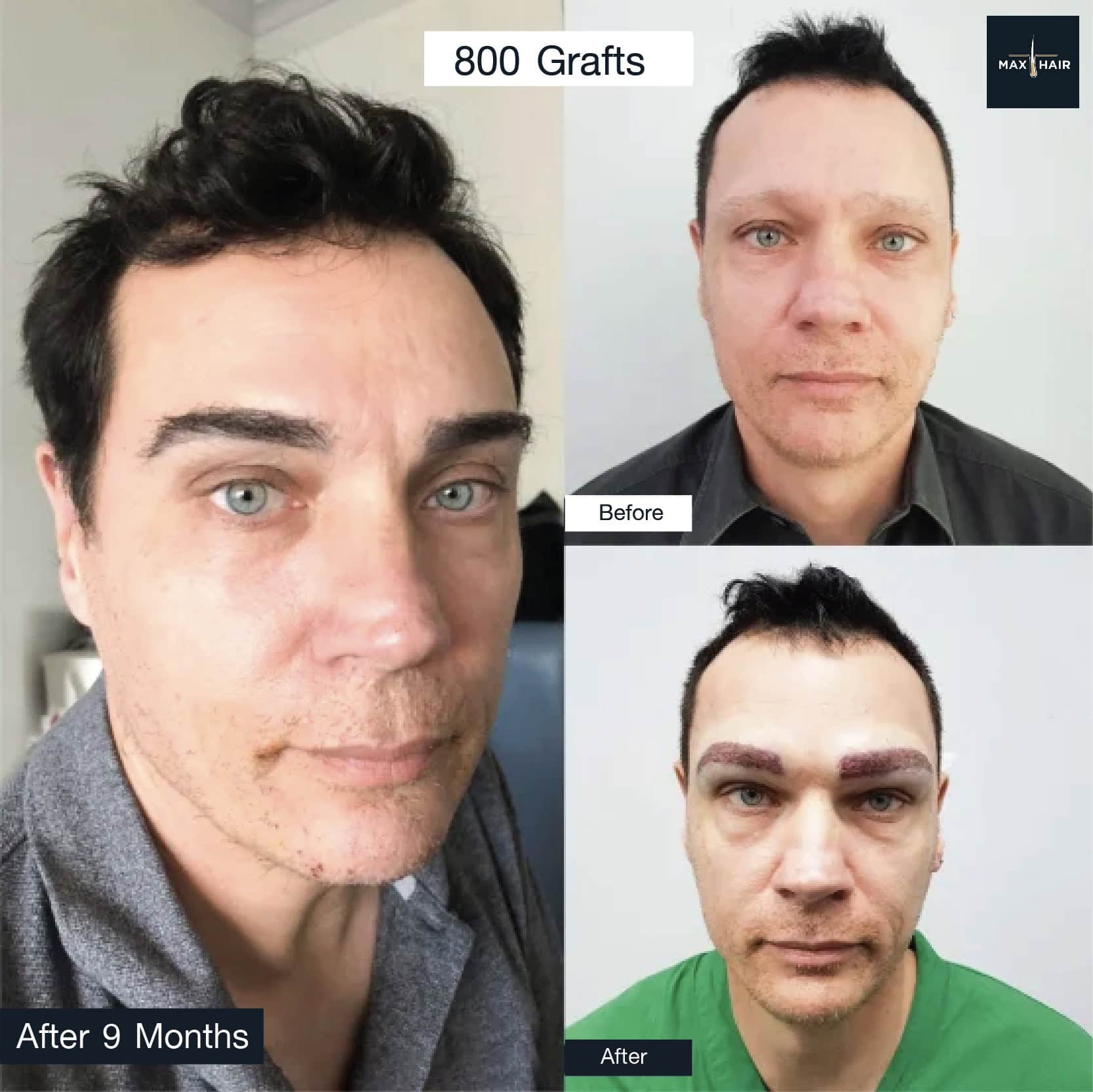 Hair transplant review - Grow eyebrows (ปลูกคิ้ว)