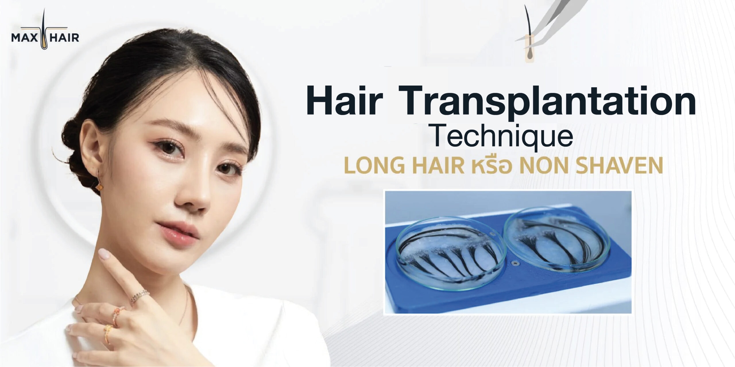 Long Hair Transplant or Non-Shaven Technique by Max Hair Thailand