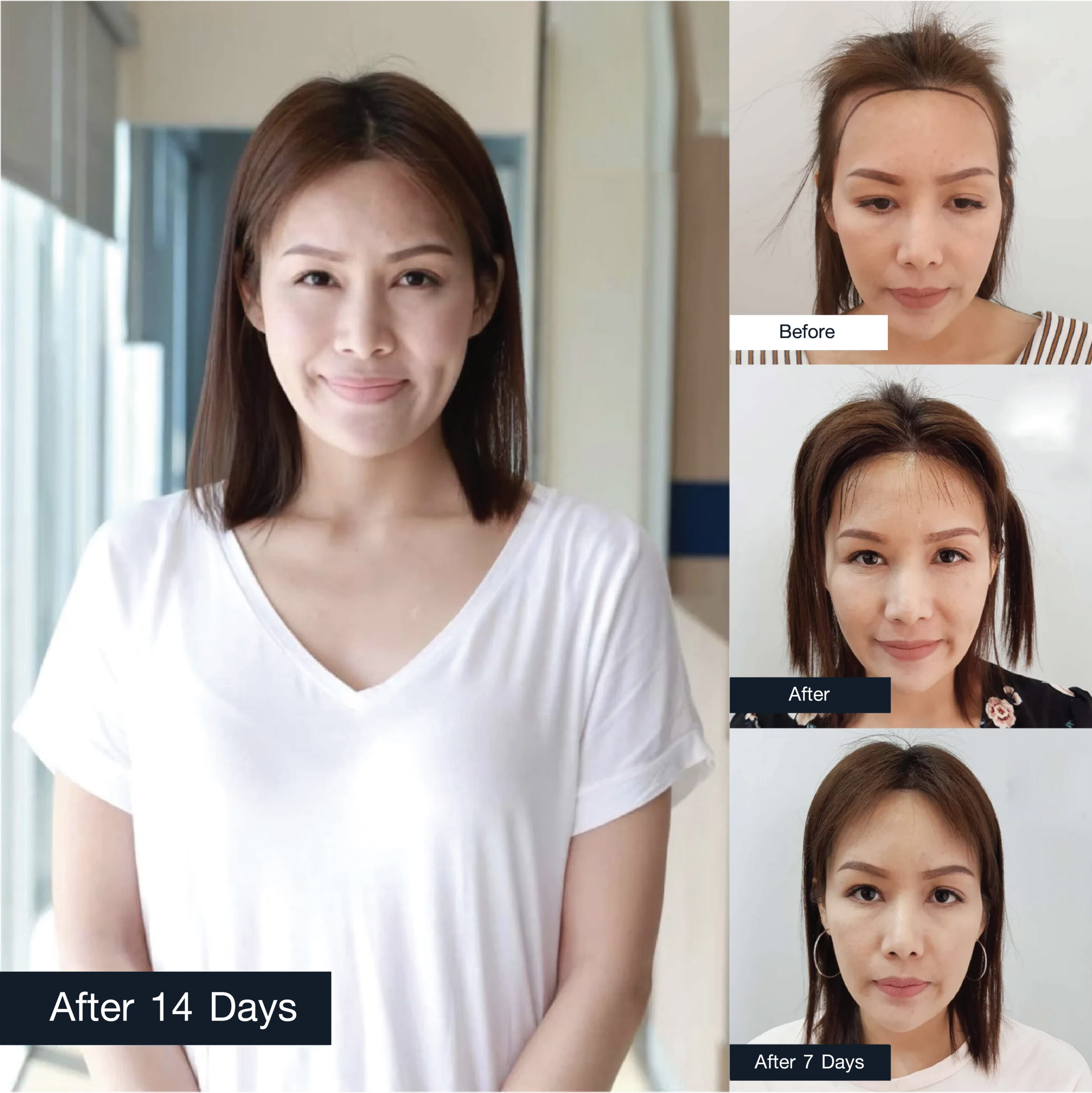 A collage showing the hair restoration progress of a woman.