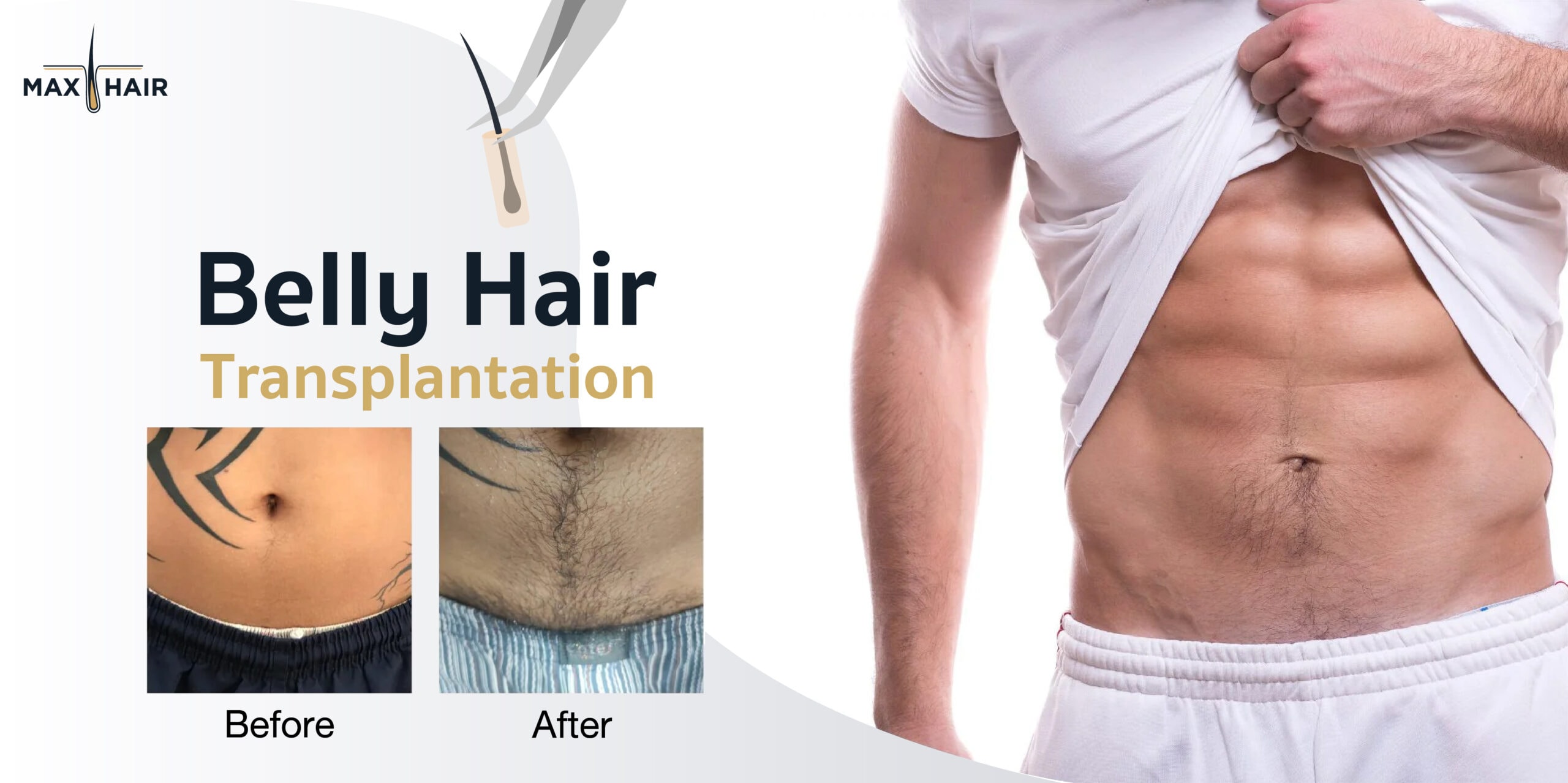 Hair transplant service for the abdomen to boost confidence