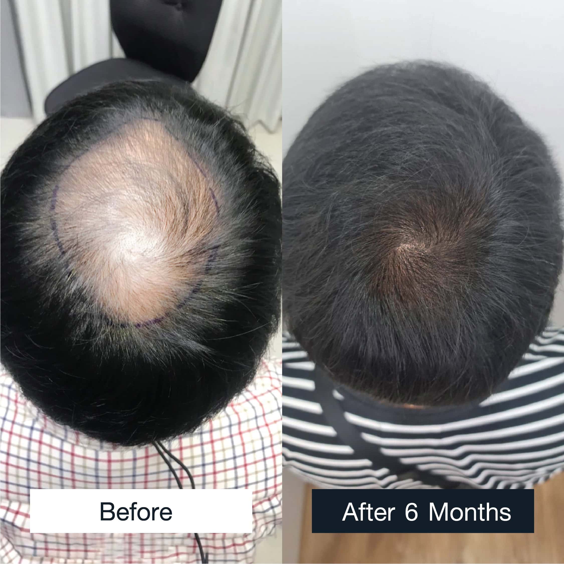 hair transplant results with PRP (Platelet Rich Plasma) technique