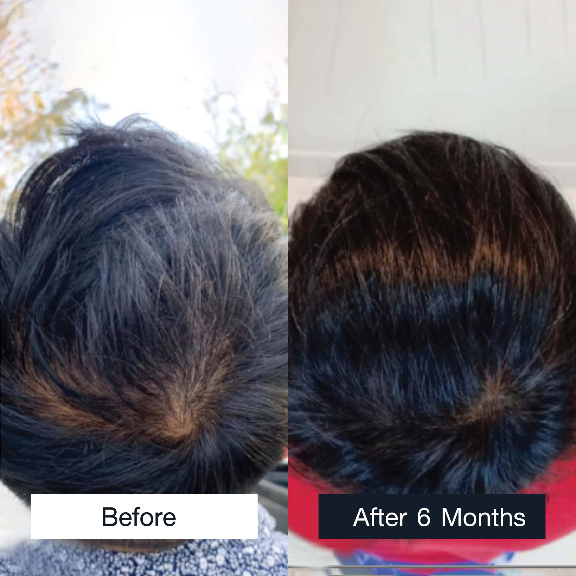 Side by side comparison of a man's head before and after hair thinning treatment