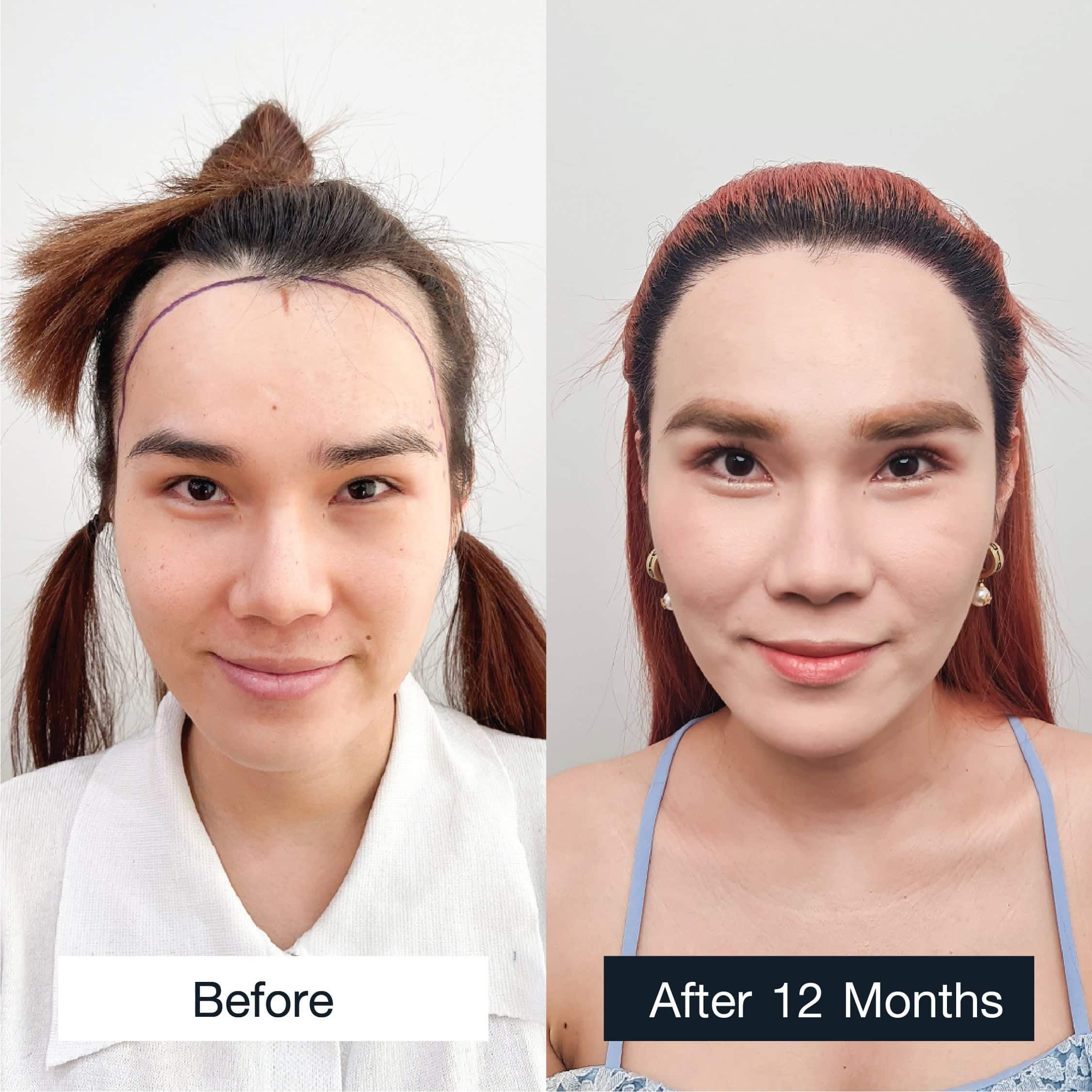 Before and after FUE 2,500 grafts hair transplant in a woman, 12 months result