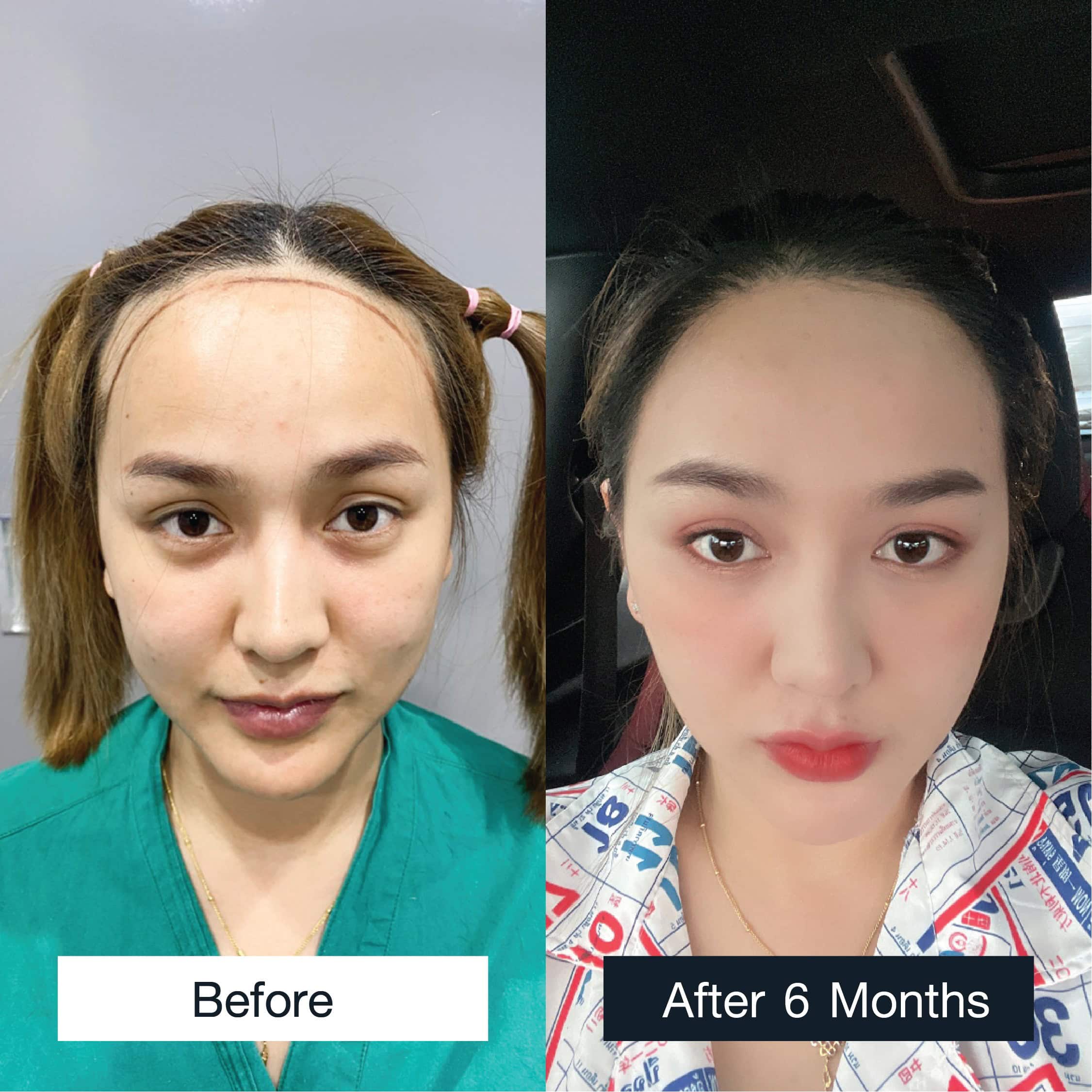 Female hair transplant result after 6 months showing fuller and more balanced hairline.