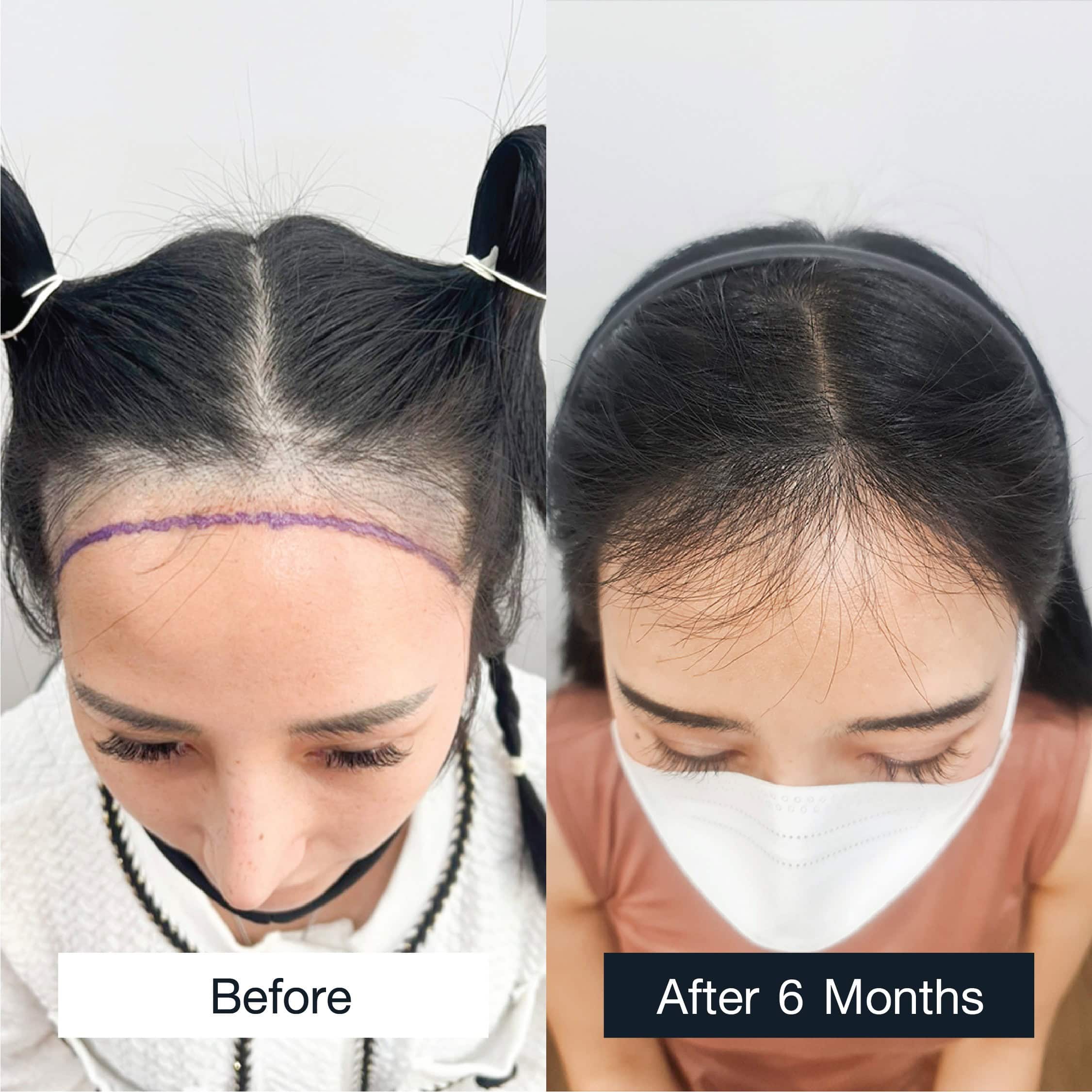 Before and after MCG 3,000 grafts hair transplant in a woman, 6 months result