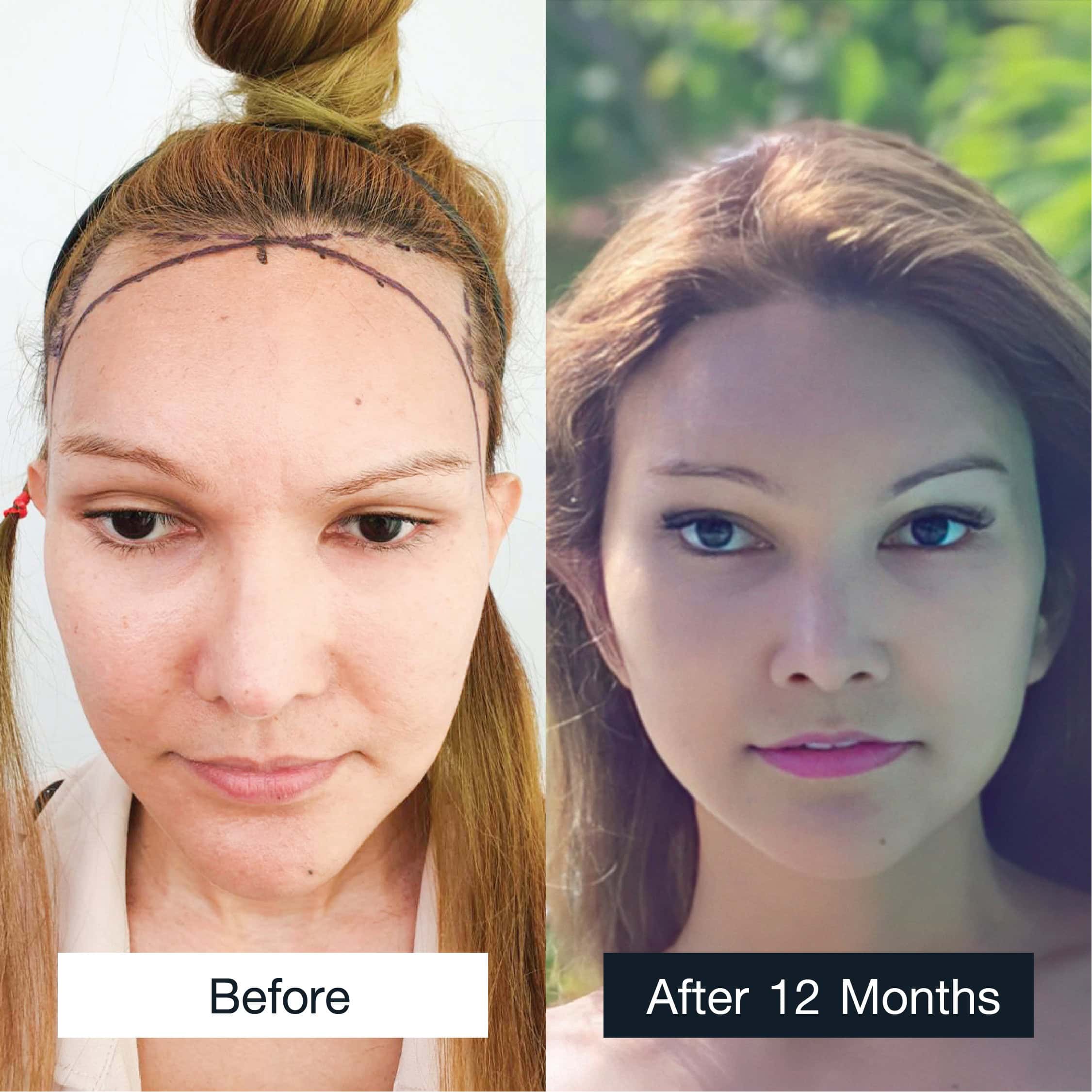 Female hair transplant results MCG 2,200 grafts after 12 months