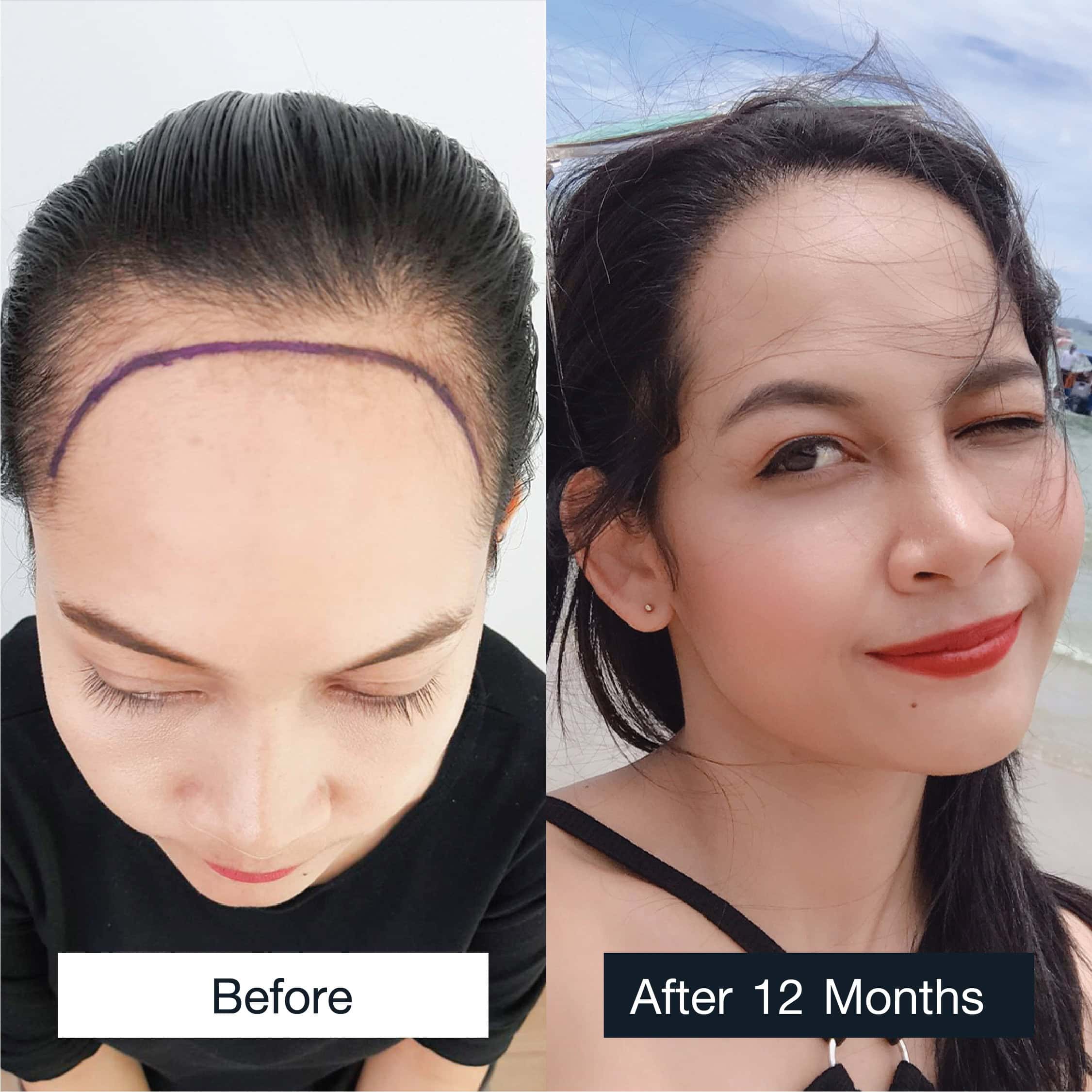 Female hair transplant results MCG 1,200 grafts after 12 months