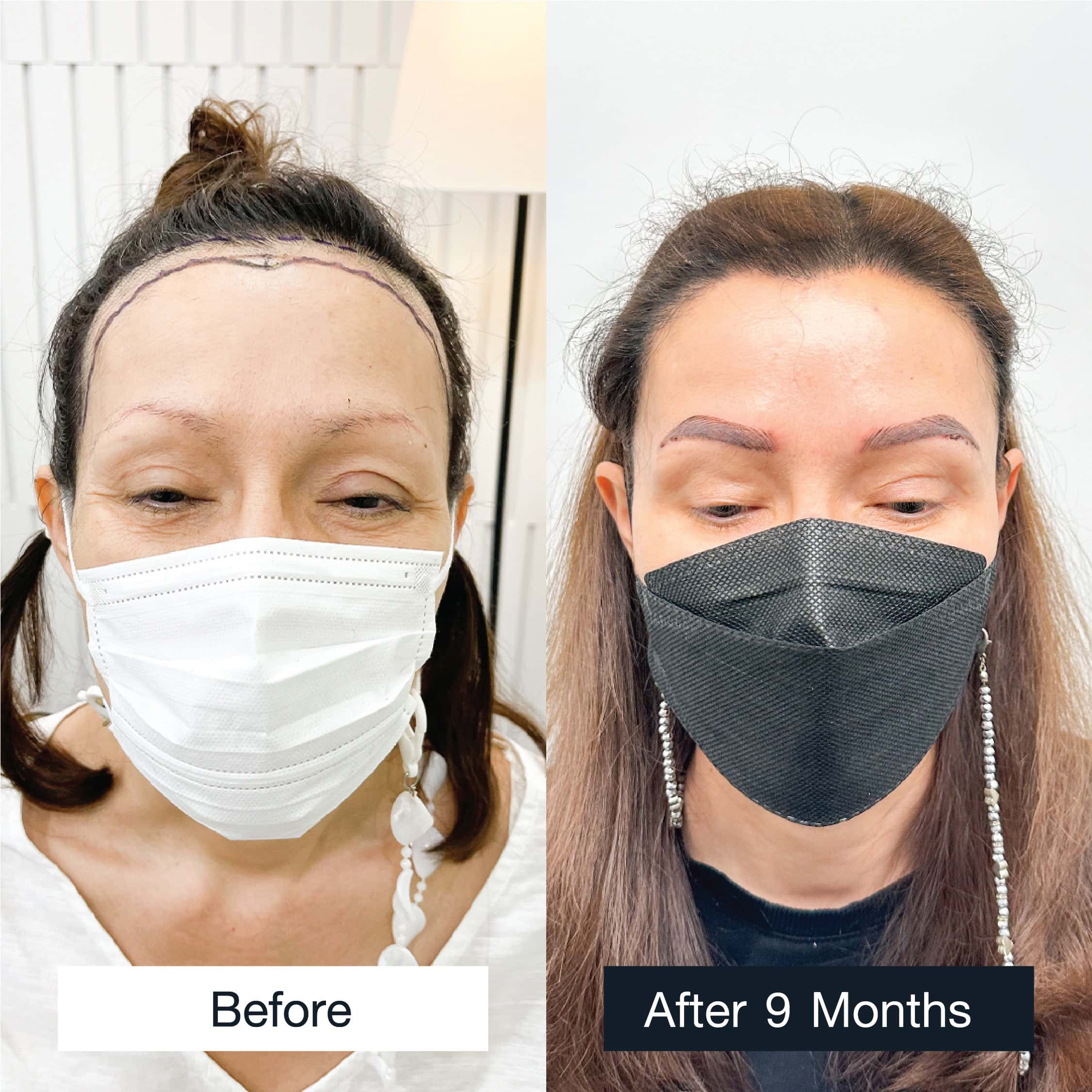 Woman's hair transplant before and after demonstrating satisfied results