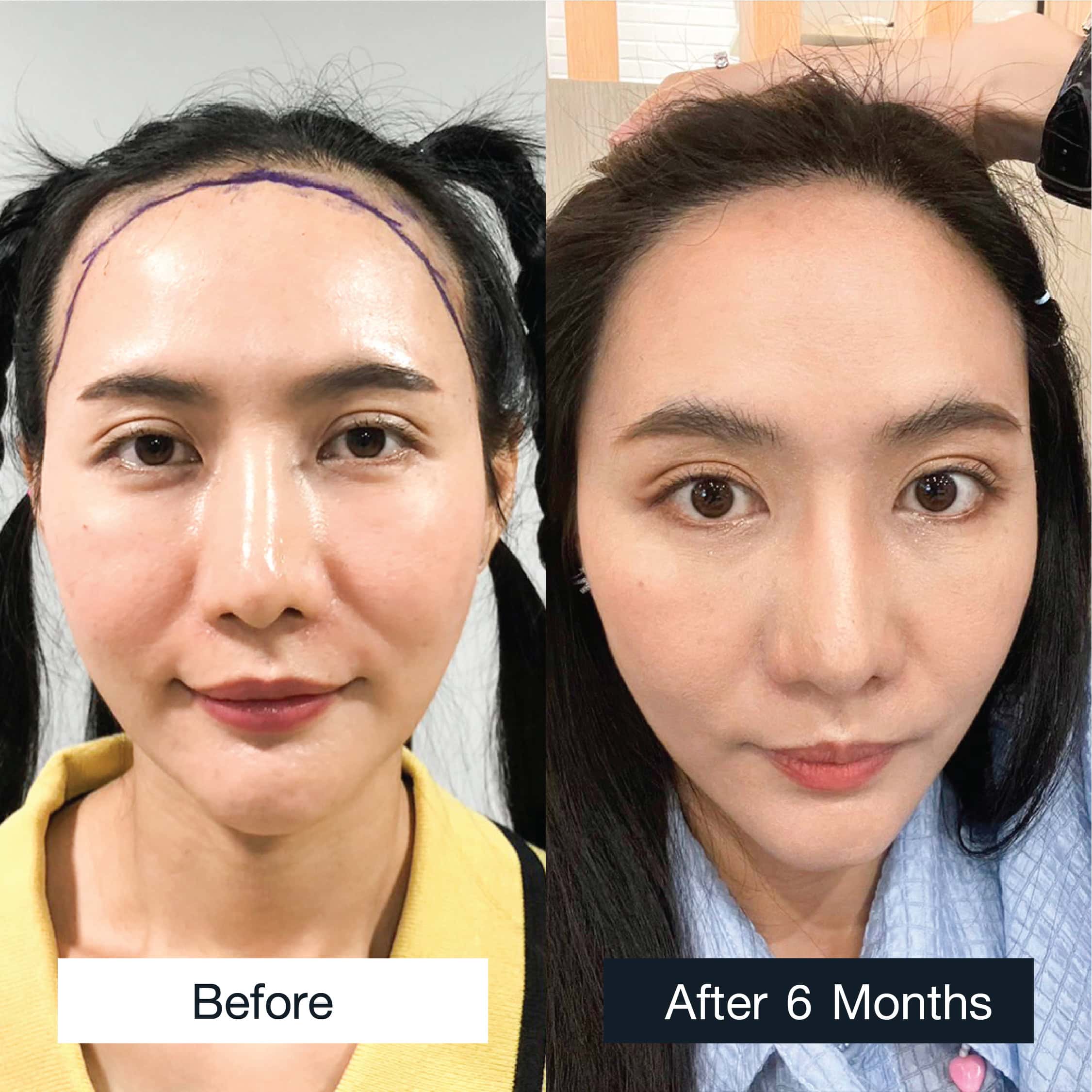 Before and after MCG 2,000 grafts hair transplant in a woman, 6 months result