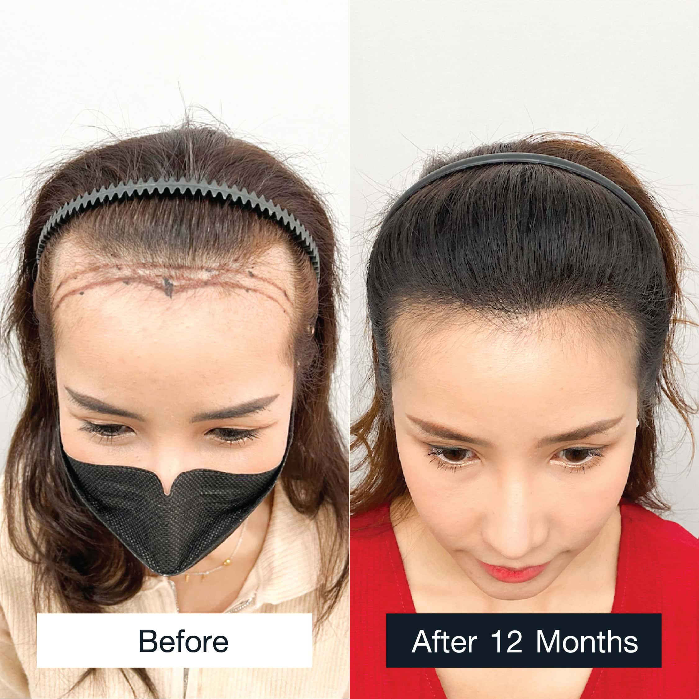 Women's hair transplant review case: MCG technique, 1,500 grafts