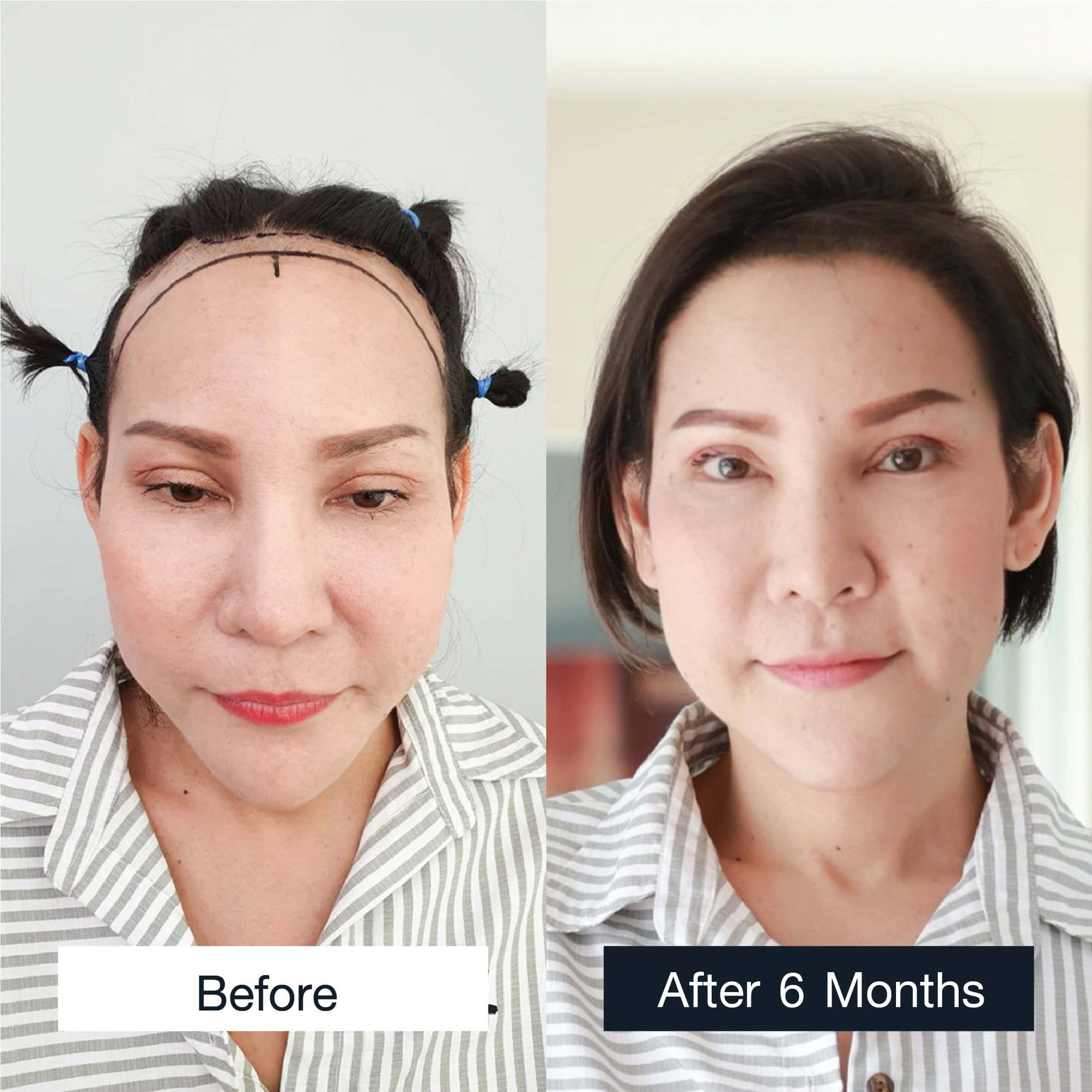 Before and after female MCG hair transplant, 3,200 grafts, 6 months