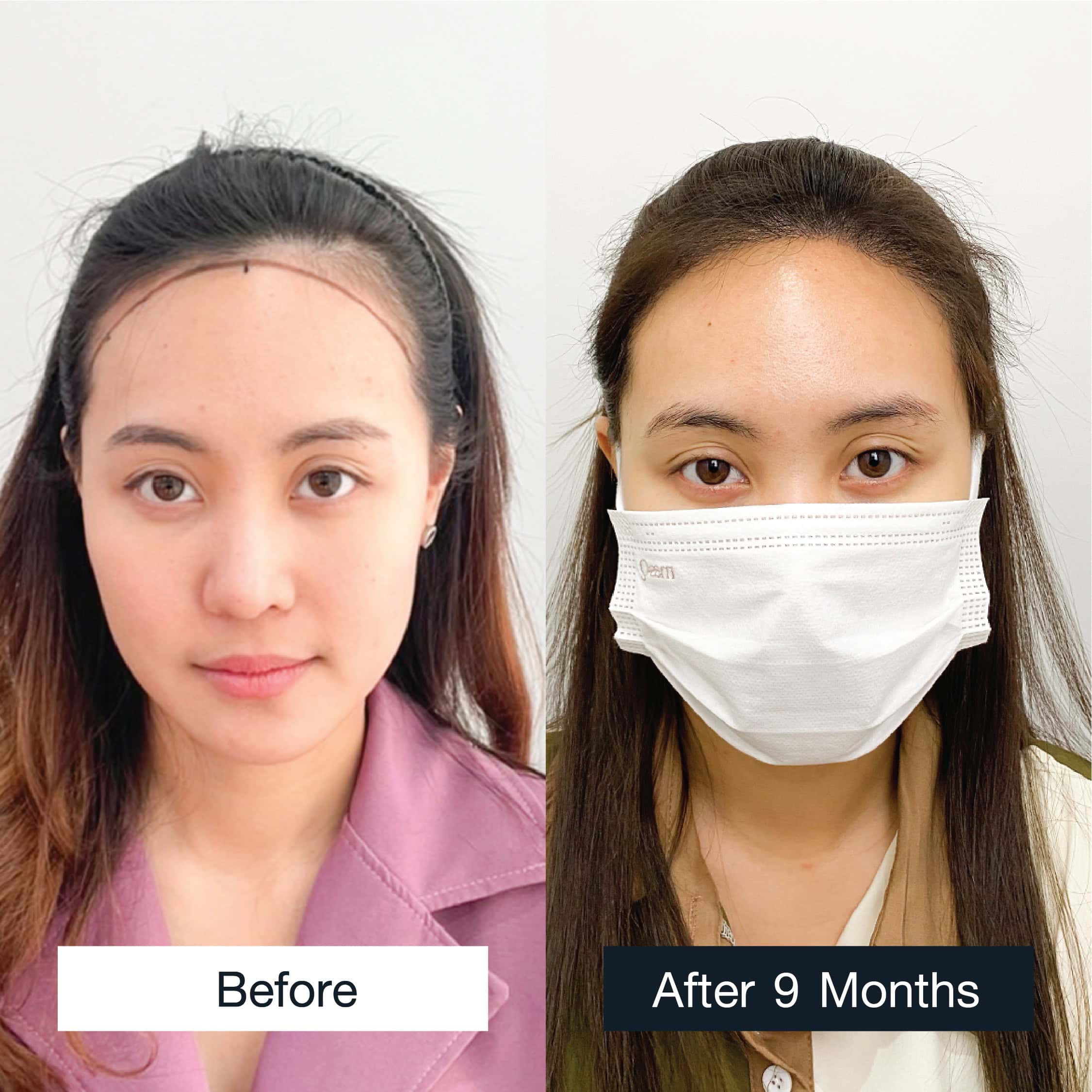 Before and after MCG 1,500 grafts hair transplant in a woman, 9 months result