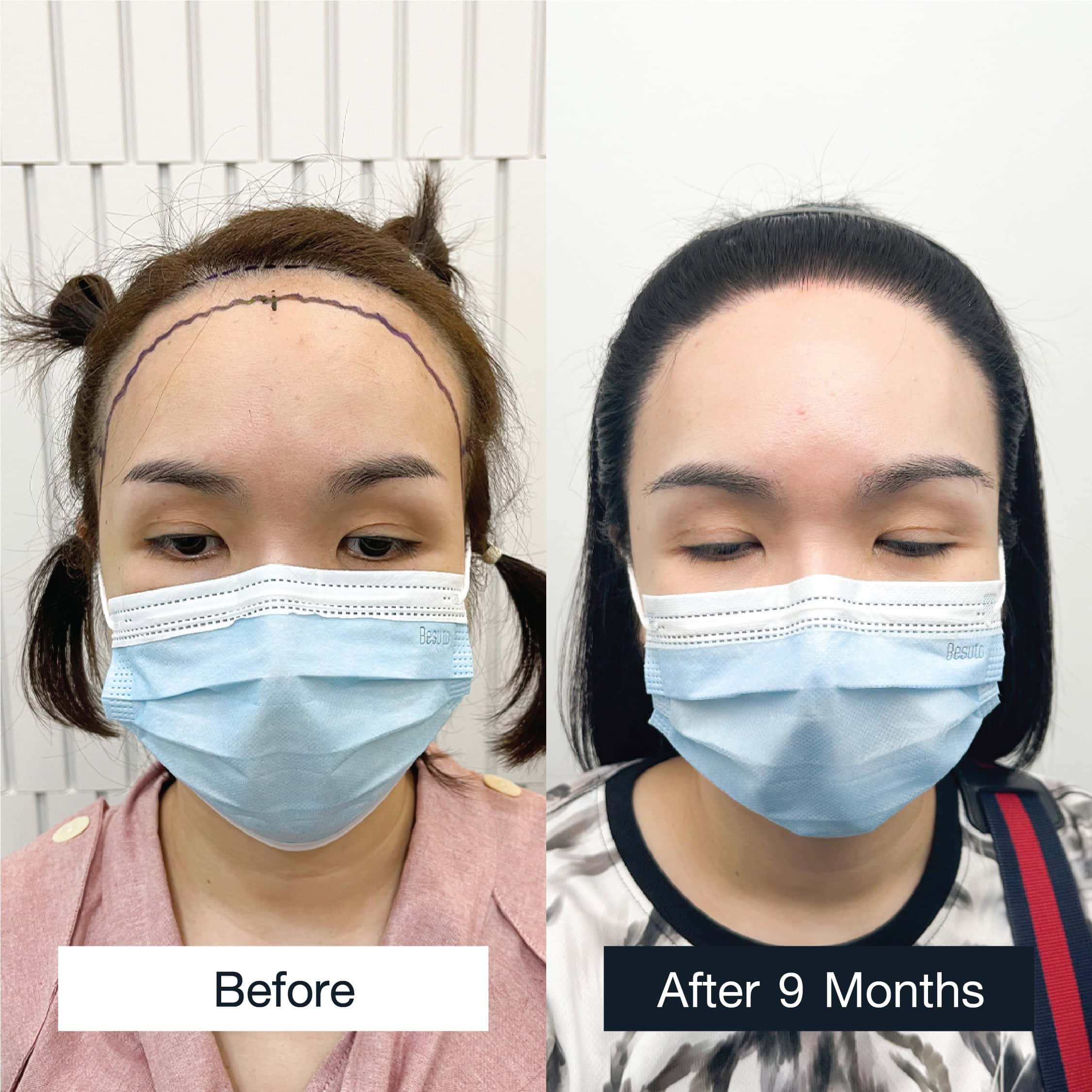 Hairline transformation in woman before and after 9 months of hair transplant procedure.