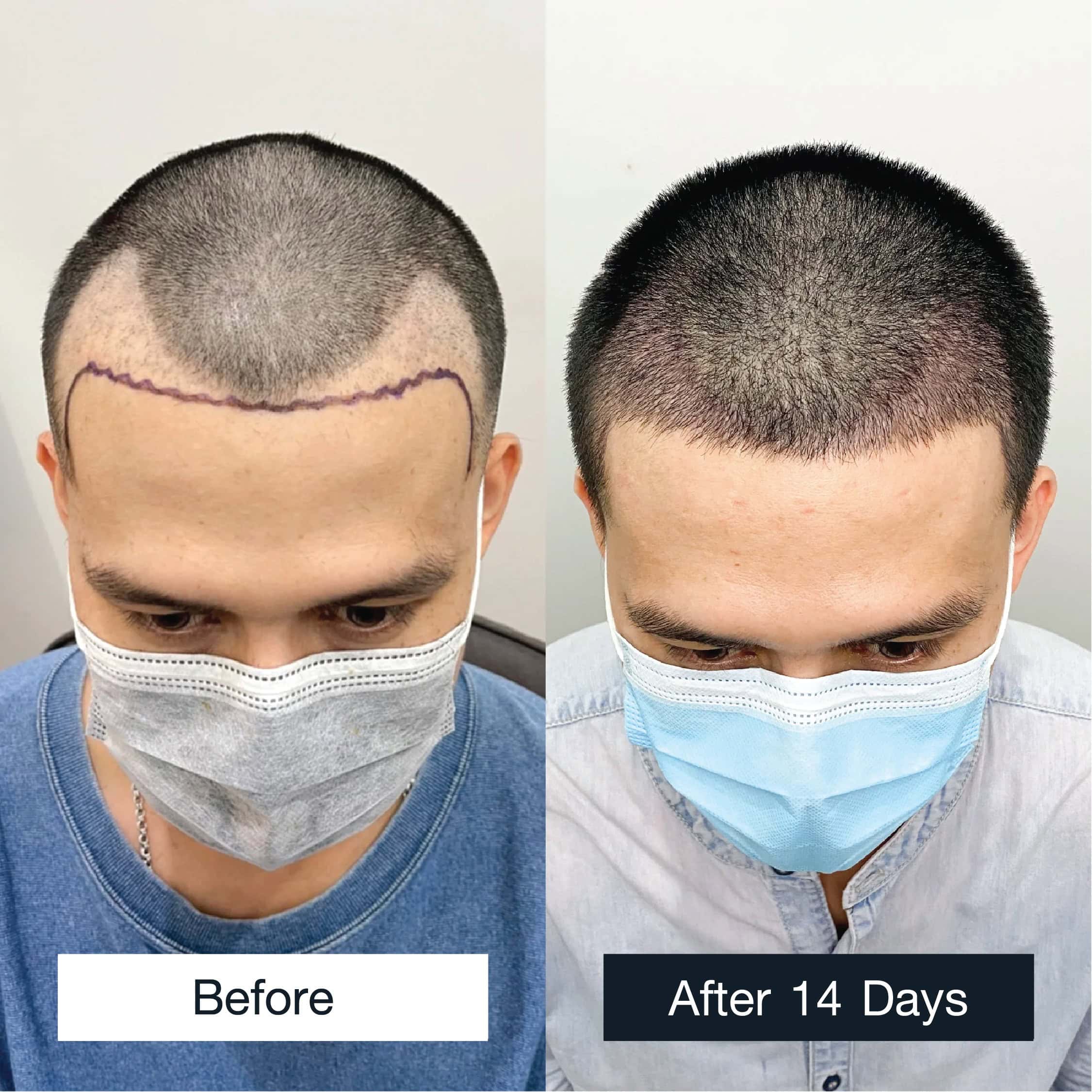 Male hair transplant before and after photos showing real case review results - Max Hair