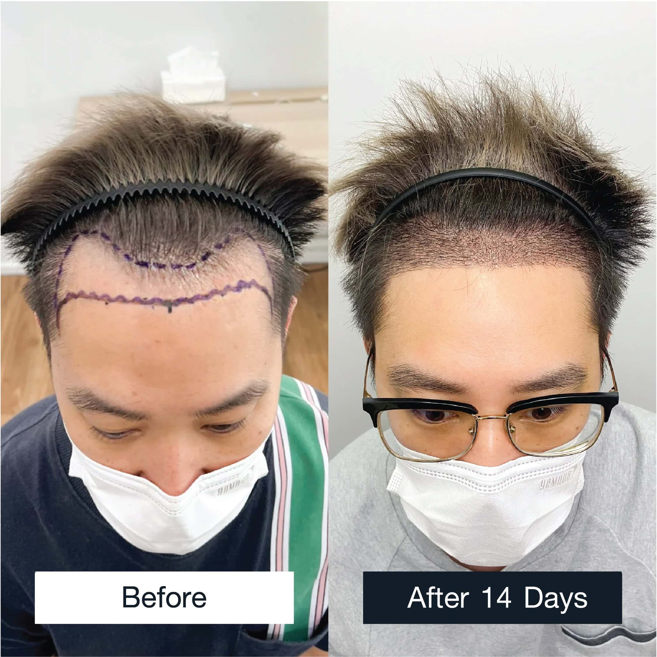 เปรียบเทียบก่อนและหลังปลูกผม FUE 2,000 กราฟต์หลังผ่านไป 14 วัน