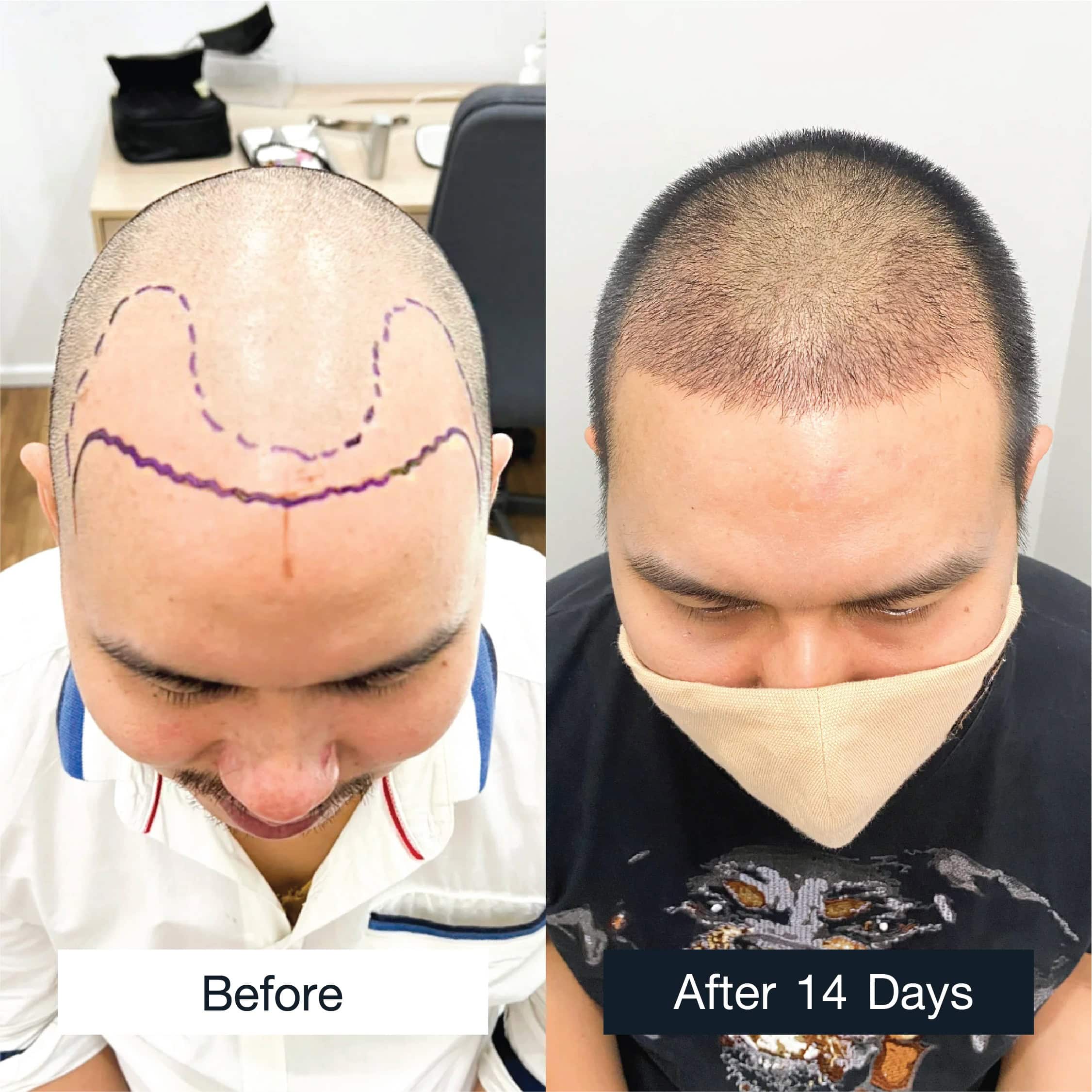 FUE hair transplant before and after 14 days in man with receding hairline, 2,700 grafts.