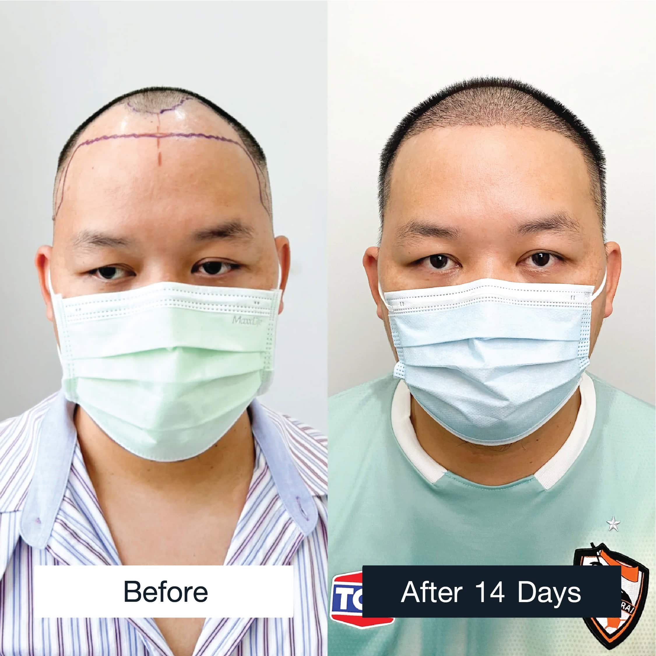 Female hair transplant results MCG 3,000 grafts after 14 days