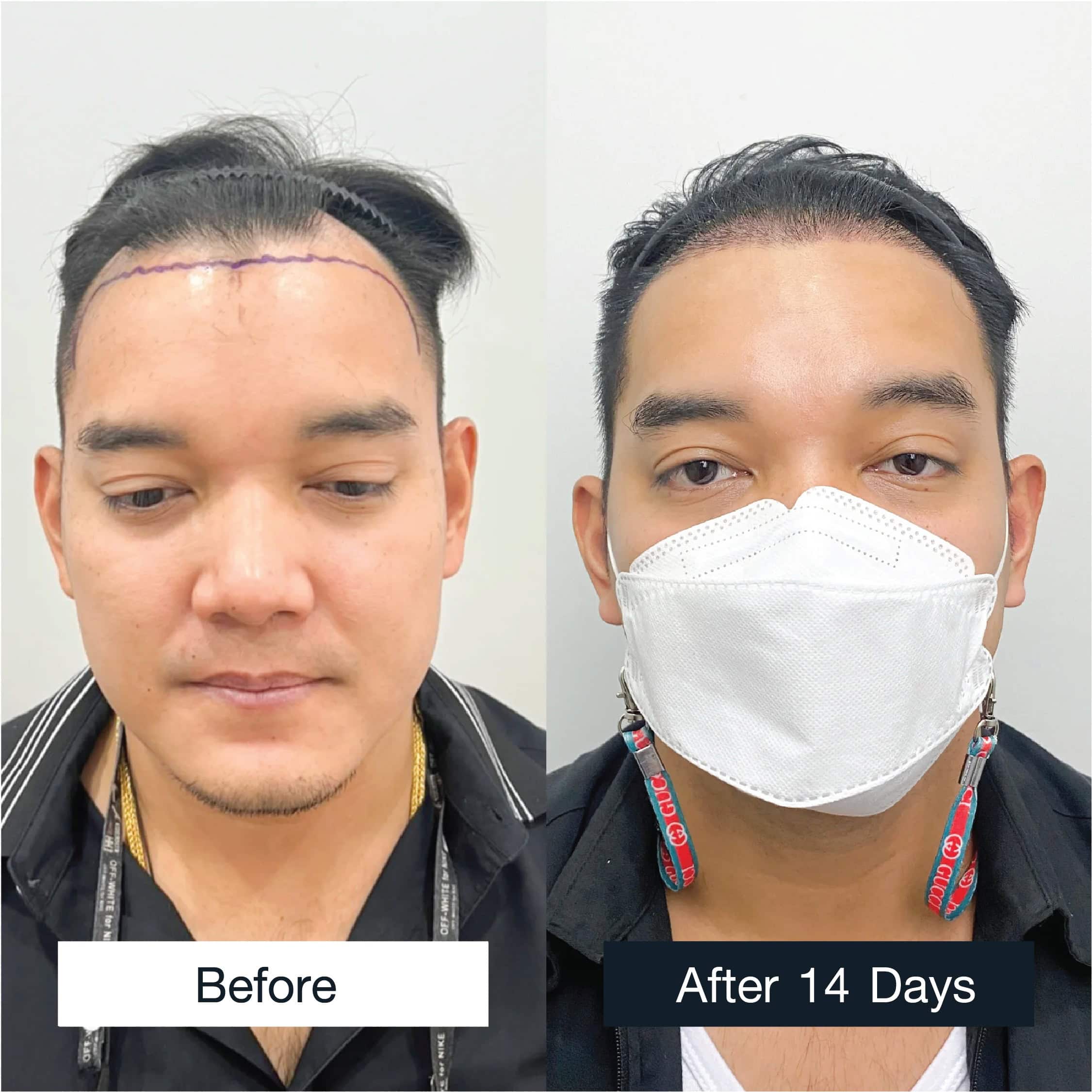 Female FUE hair transplant results 2,500 grafts after 14 days