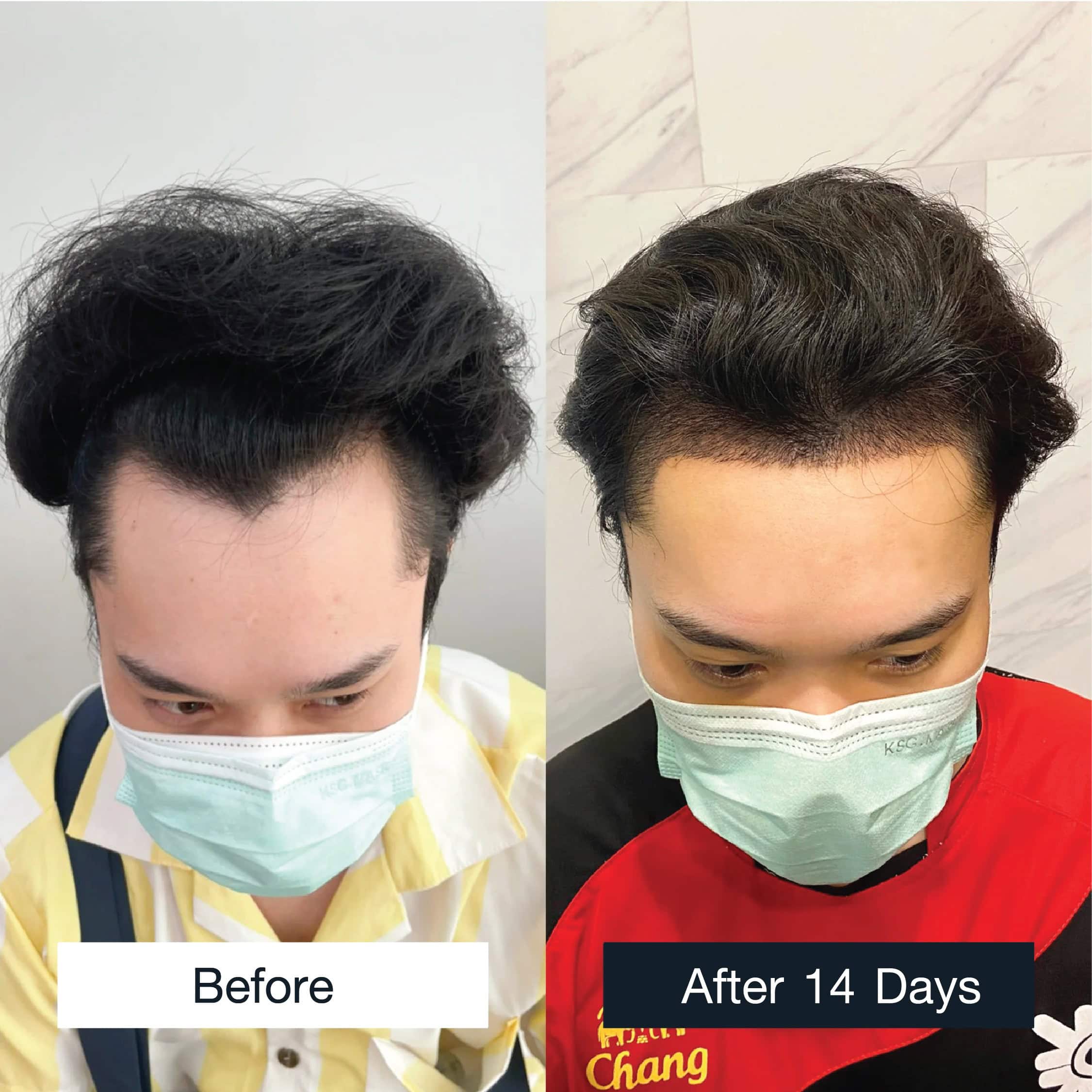 a male hair transplant review case, MCG technique, 2,650 grafts