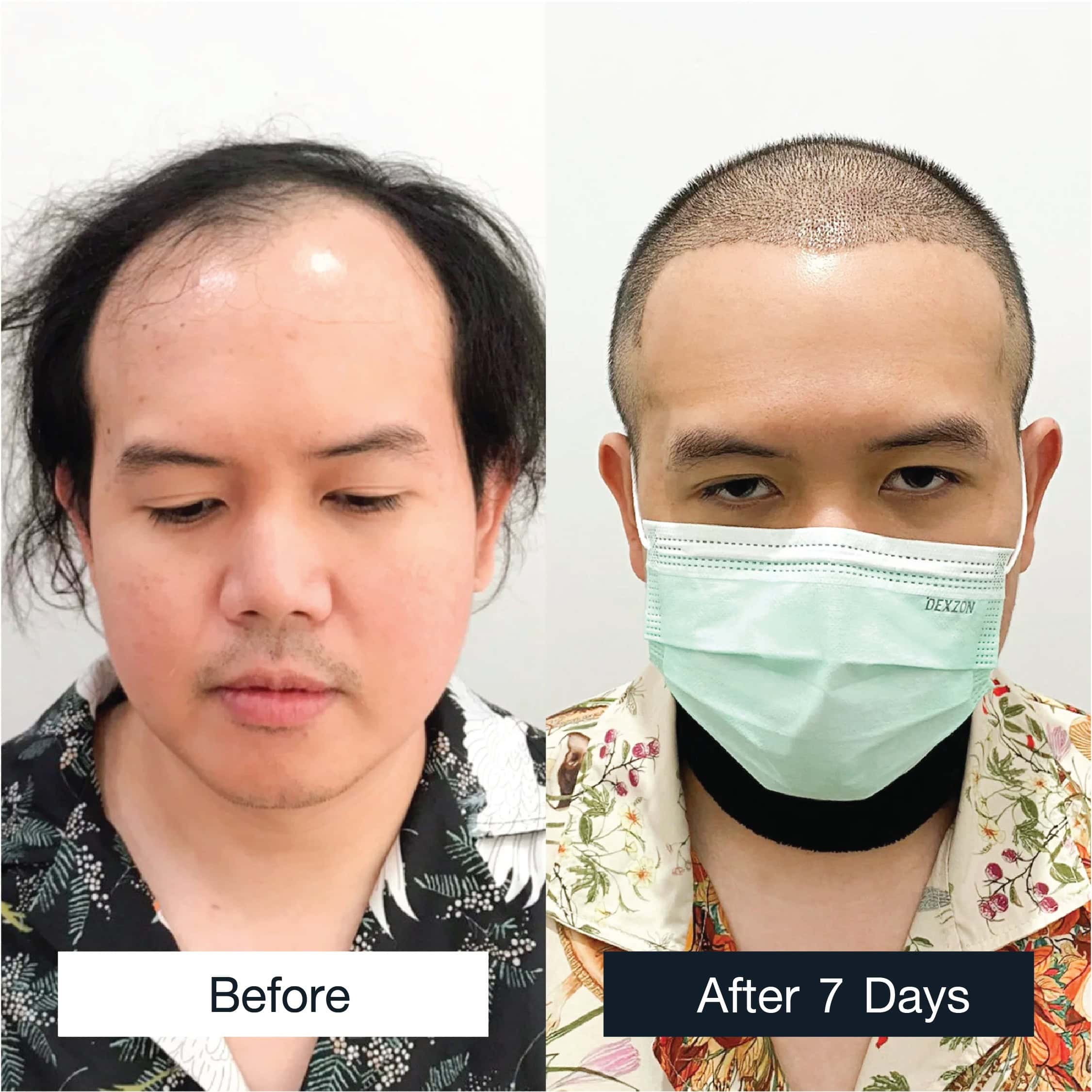 Ia male hair transplant review case, MCG technique, 3,100 grafts