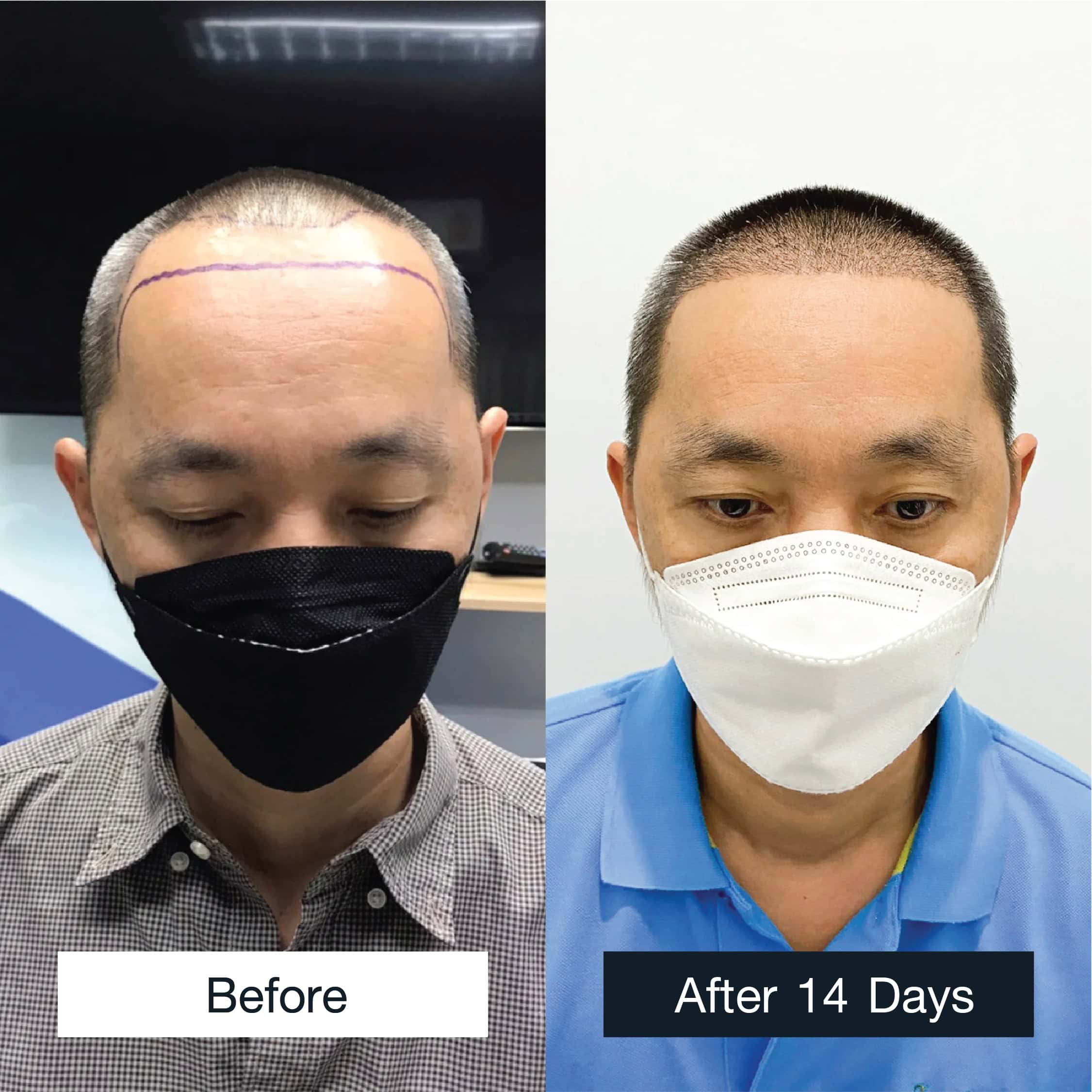 Male FUE hair transplant results 2,600 grafts after 14 days