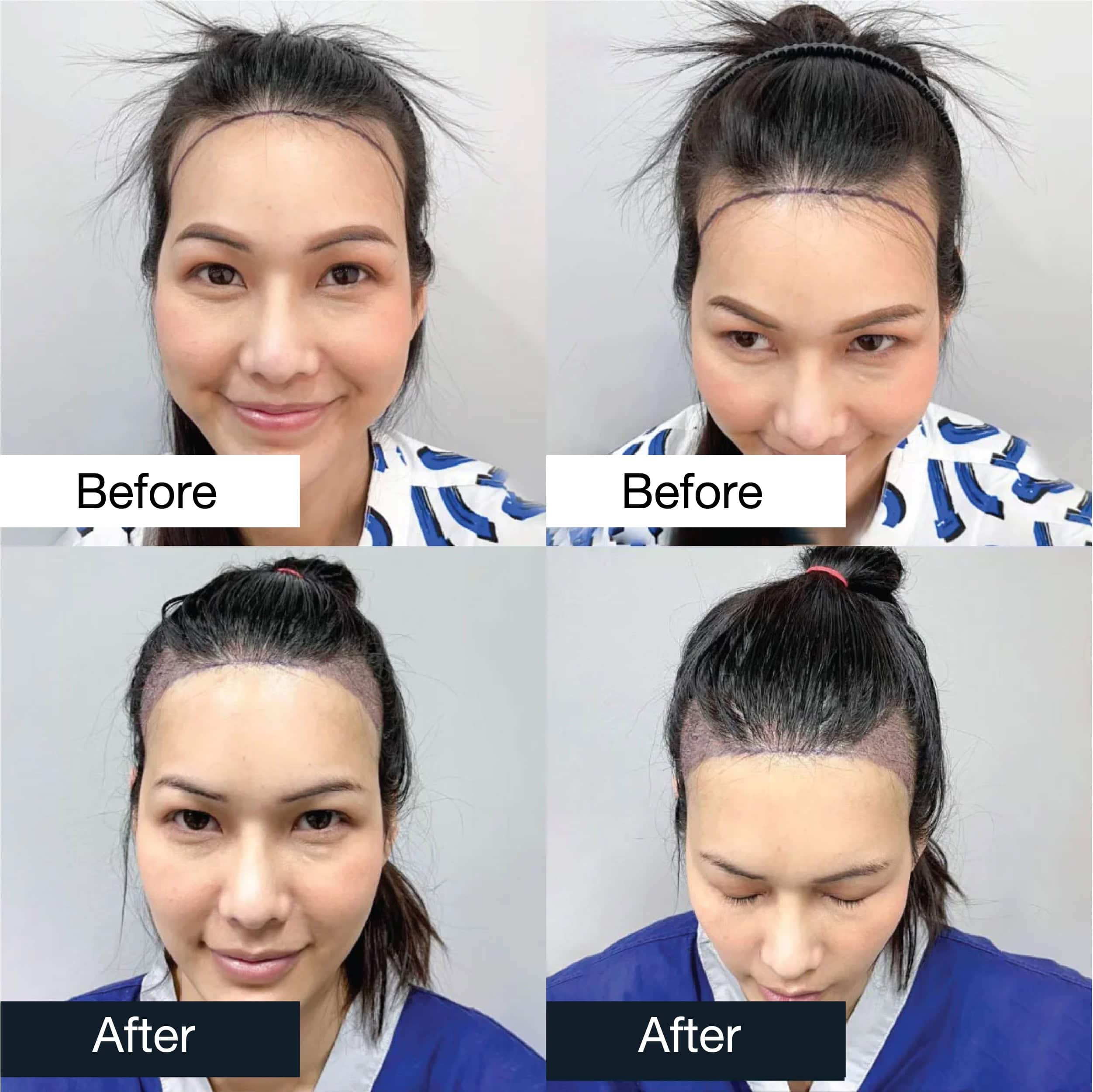 Multi-angle hair transplant before and after in woman showing improved hairline design and coverage.