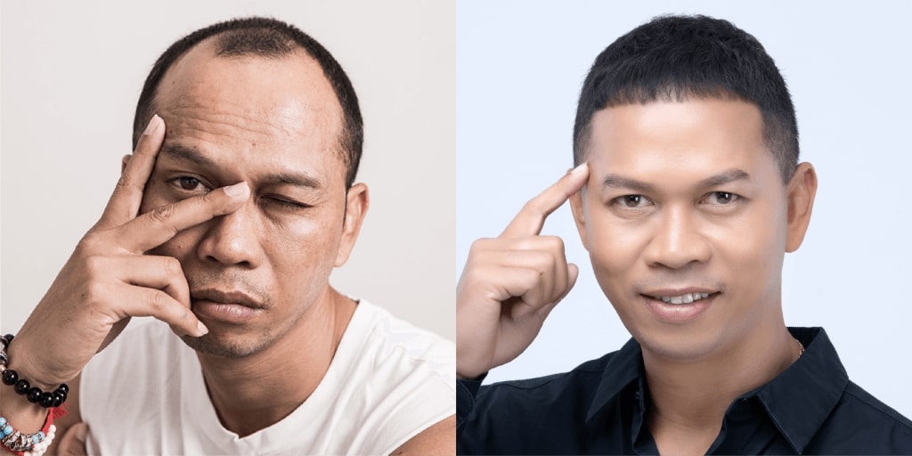 รีวิวก่อนการปลูกผมของคุณสมจิตร จงจอหอ