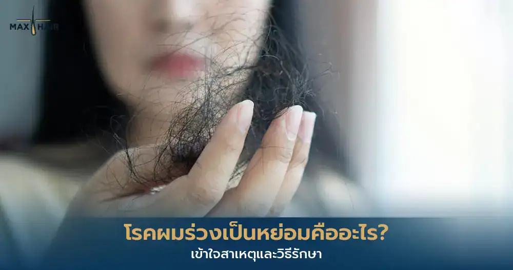 ผมร่วงเป็นหย่อม