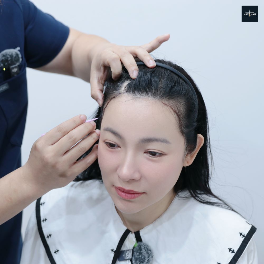 คุณต้นหอม-ศกุนตลา นักแสดงและพิธีกรชื่อดัง เข้ารับบริการปลูกผมเทคนิค Long Hair