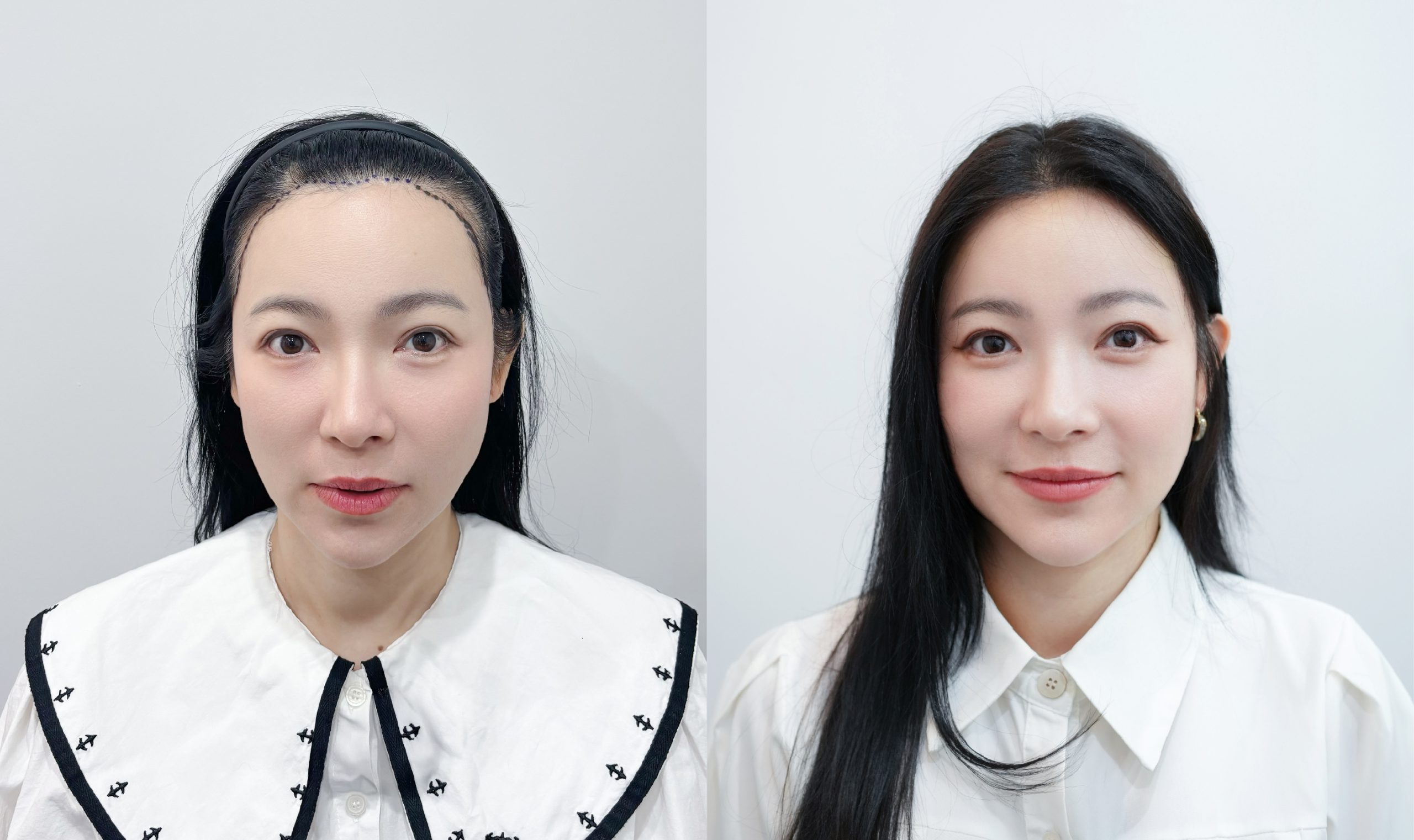 รีวิวปลูกผมผู้หญิงโดยคุณต้นหอม ศกุนตลา ด้วยเทคนิค Long Hair