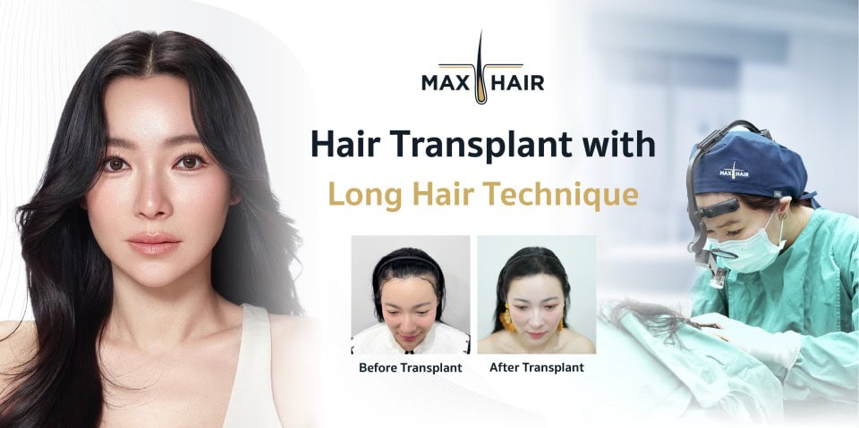 Promotion for Hair Transplantation for those with Long Hair at Max Hair Clinic