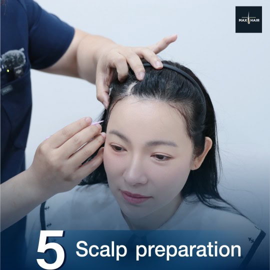 Doctor at Max Hair Clinic preparing a patient's scalp for hair transplantation