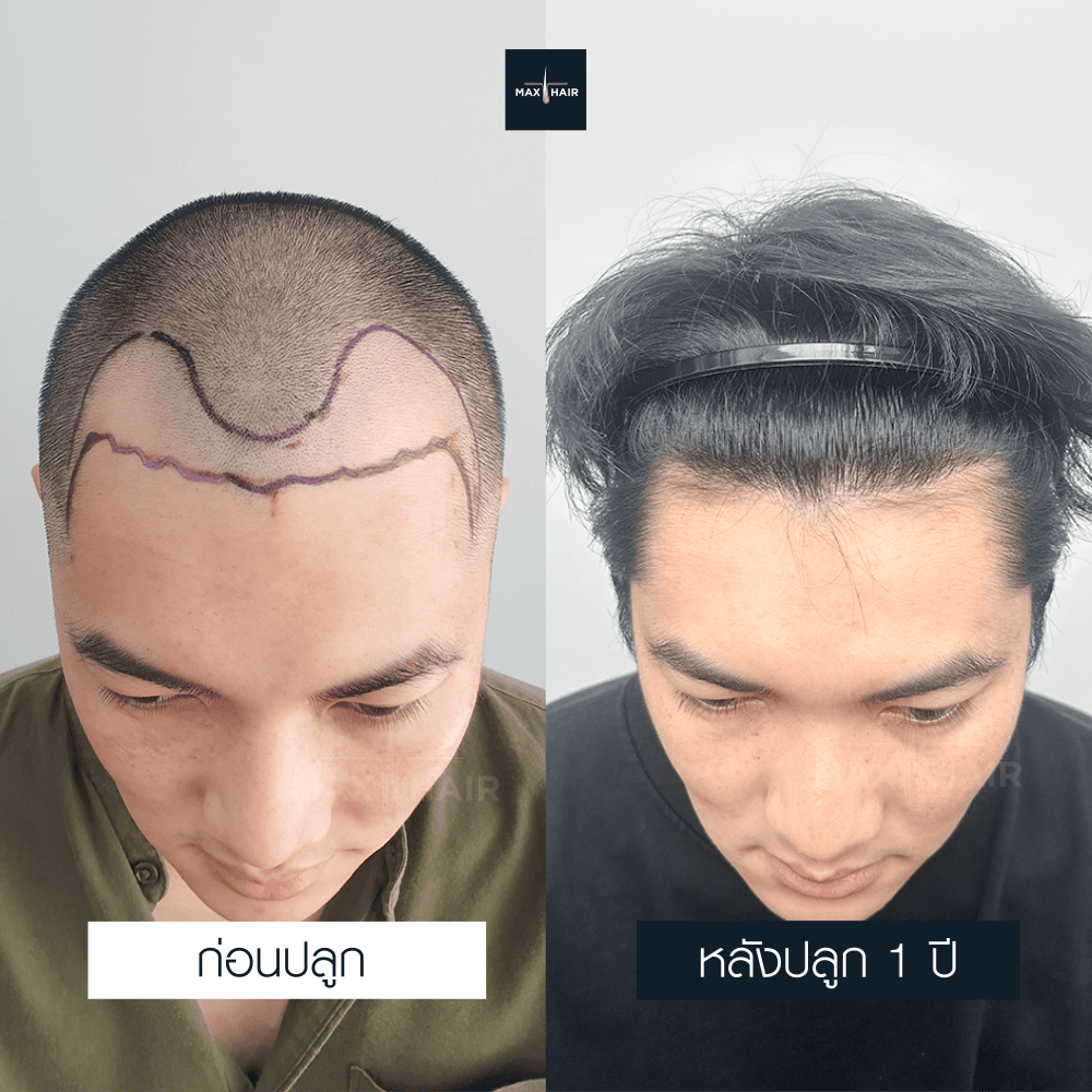 ปลูกผม MCG 2300 กราฟ คุณธนพงศ์ ปังอุทา - Max Hair