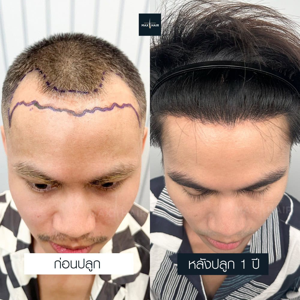 ปลูกผม MCG 2400 กราฟ คุณธนากร ถินถาวร - Max Hair (2)