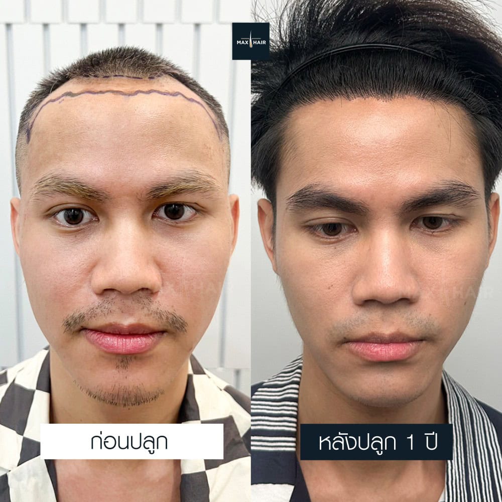 ปลูกผม MCG 2400 กราฟ คุณธนากร ถินถาวร - Max Hair (1)