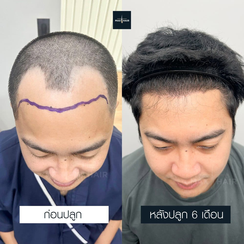 ปลูกผม MCG 2800 กราฟ คุณนภพล ภูยาธร - Max Hair (1)
