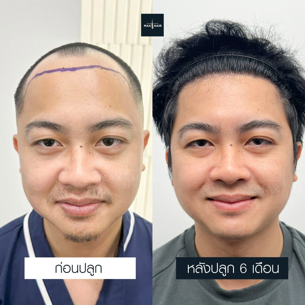 ปลูกผม MCG 2800 กราฟ คุณนภพล ภูยาธร - Max Hair (2)
