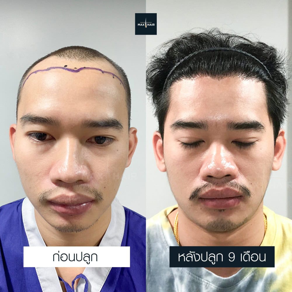 ปลูกผม MCG 2600 กราฟ คุณนาวี พรประสิทธิ์เจ๋า - Max Hair