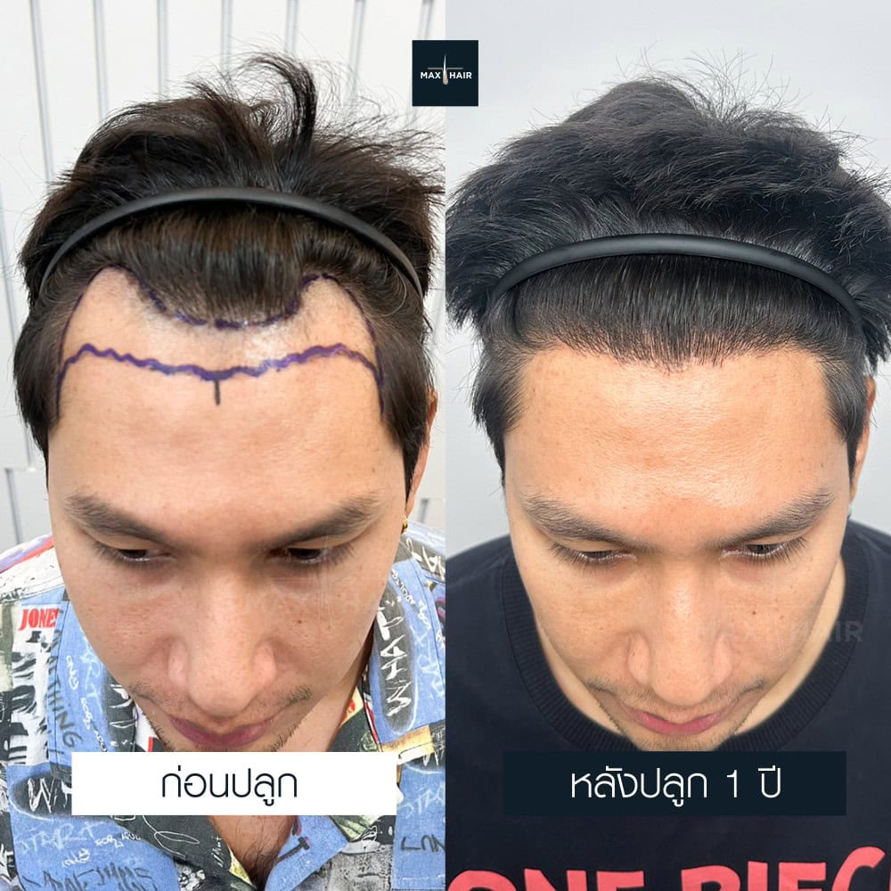 ปลูกผม FUE 1800 กราฟ คุณบรรพต ศรศิลป์ - Max Hair (1)