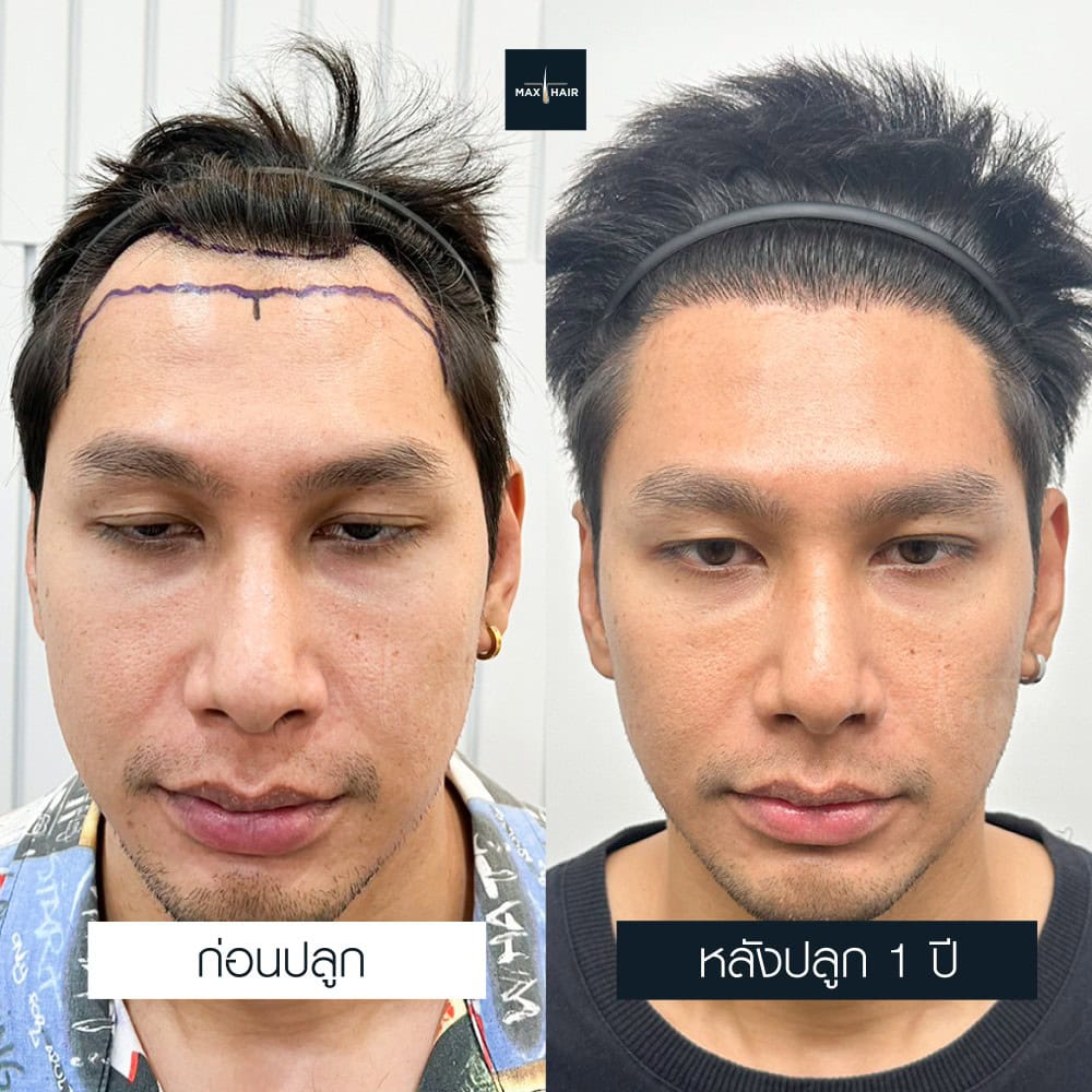 ปลูกผม FUE 1800 กราฟ คุณบรรพต ศรศิลป์ - Max Hair (2)