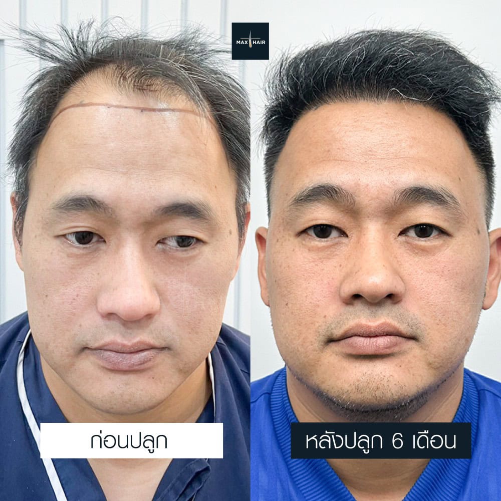 ปลูกผม MCG 3500 กราฟ คุณปวริศร์ บูชาธรรม - Max Hair