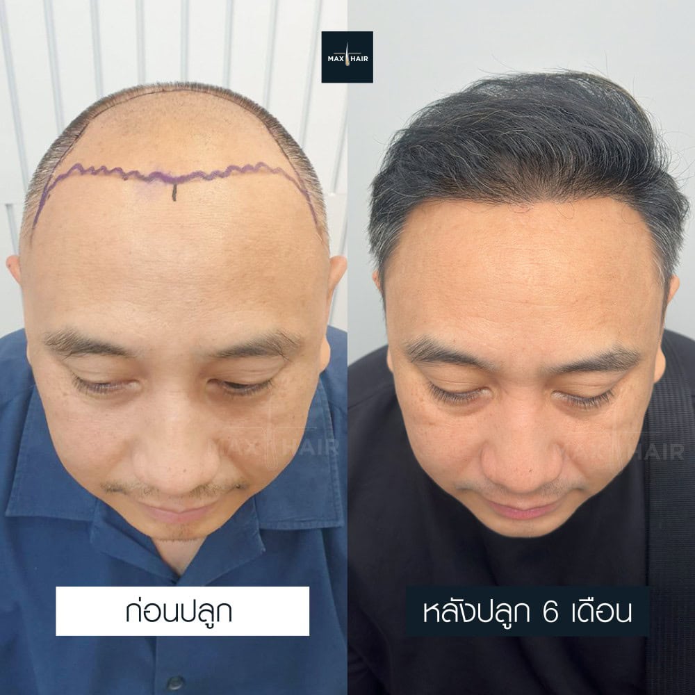 ปลูกผม MCG 3500 กราฟ คุณปิยพิทย์ โตบุญ - Max Hair