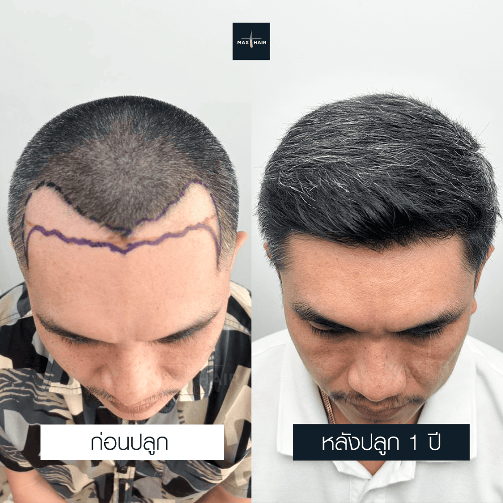 ปลูกผม MCG 2000 กราฟ คุณพิทยา พาราษฎร์ - Max Hair (2)