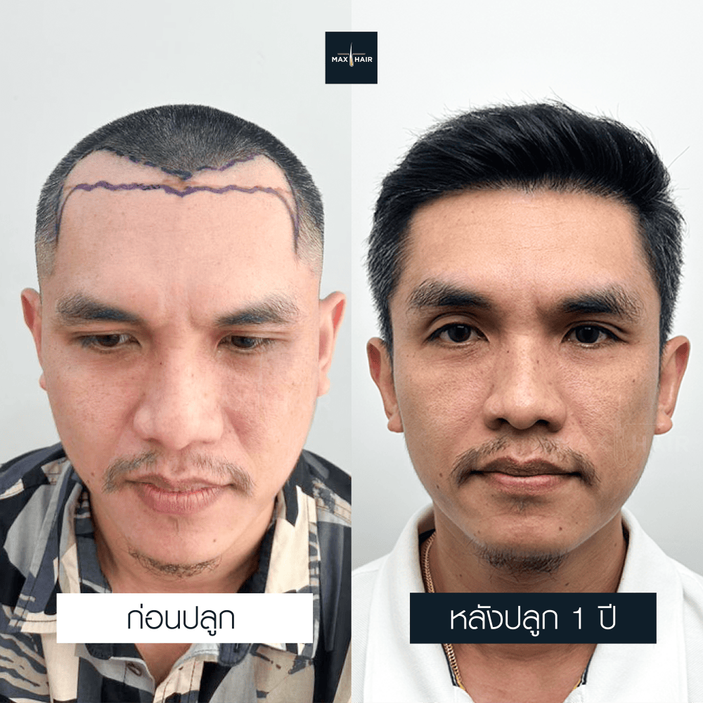 ปลูกผม MCG 2000 กราฟ คุณพิทยา พาราษฎร์ - Max Hair (1)