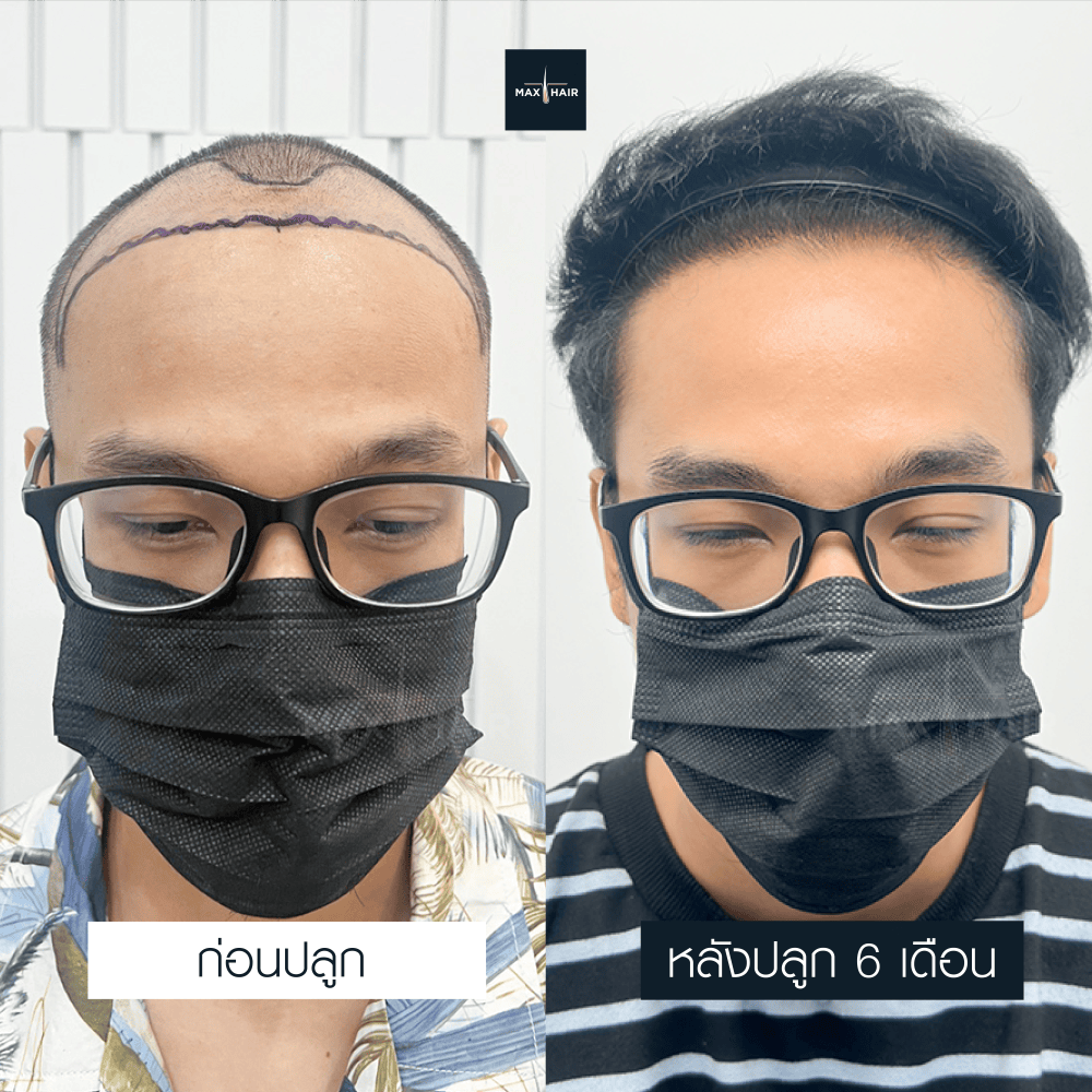 ปลูกผม MCG 3400 กราฟ คุณภาคภูมิ กองแสง - Max Hair (1)