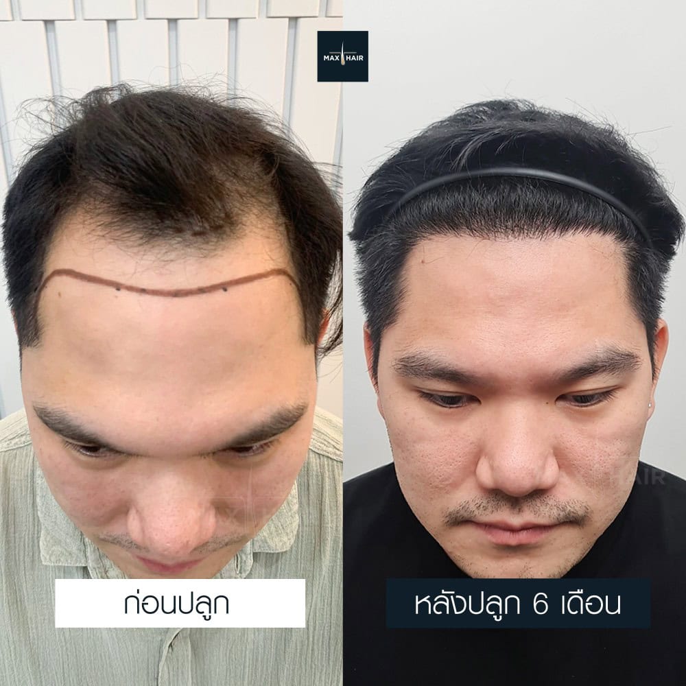 ปลูกผม MCG 3400 กราฟ คุณยศพัชร วงศ์ศิลารัตน์ - Max Hair