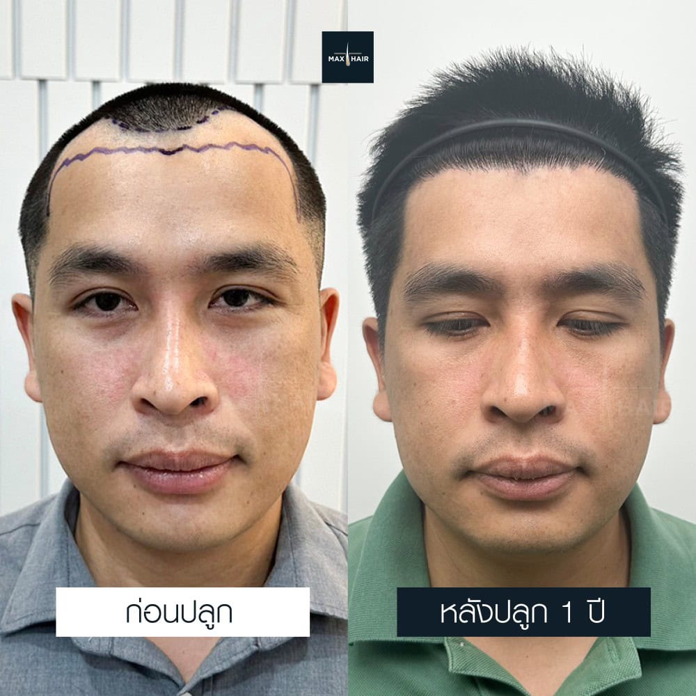 ปลูกผม MCG 2600 กราฟ คุณลำดวน พรมมะจัก - Max Hair (2)