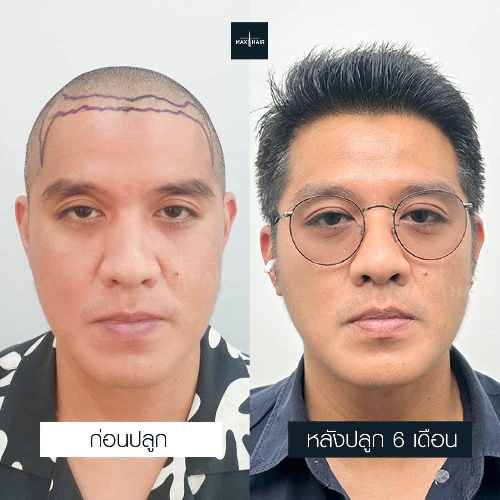 ปลูกผม MCG 2300 กราฟ คุณศุภเศรษฐ ใบเงิน - Max Hair