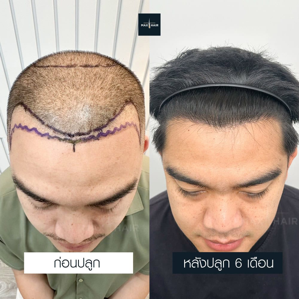ปลูกผม MCG 3600 กราฟ คุณสัจวัจน์ ชาวงิ้ว - Max Hair